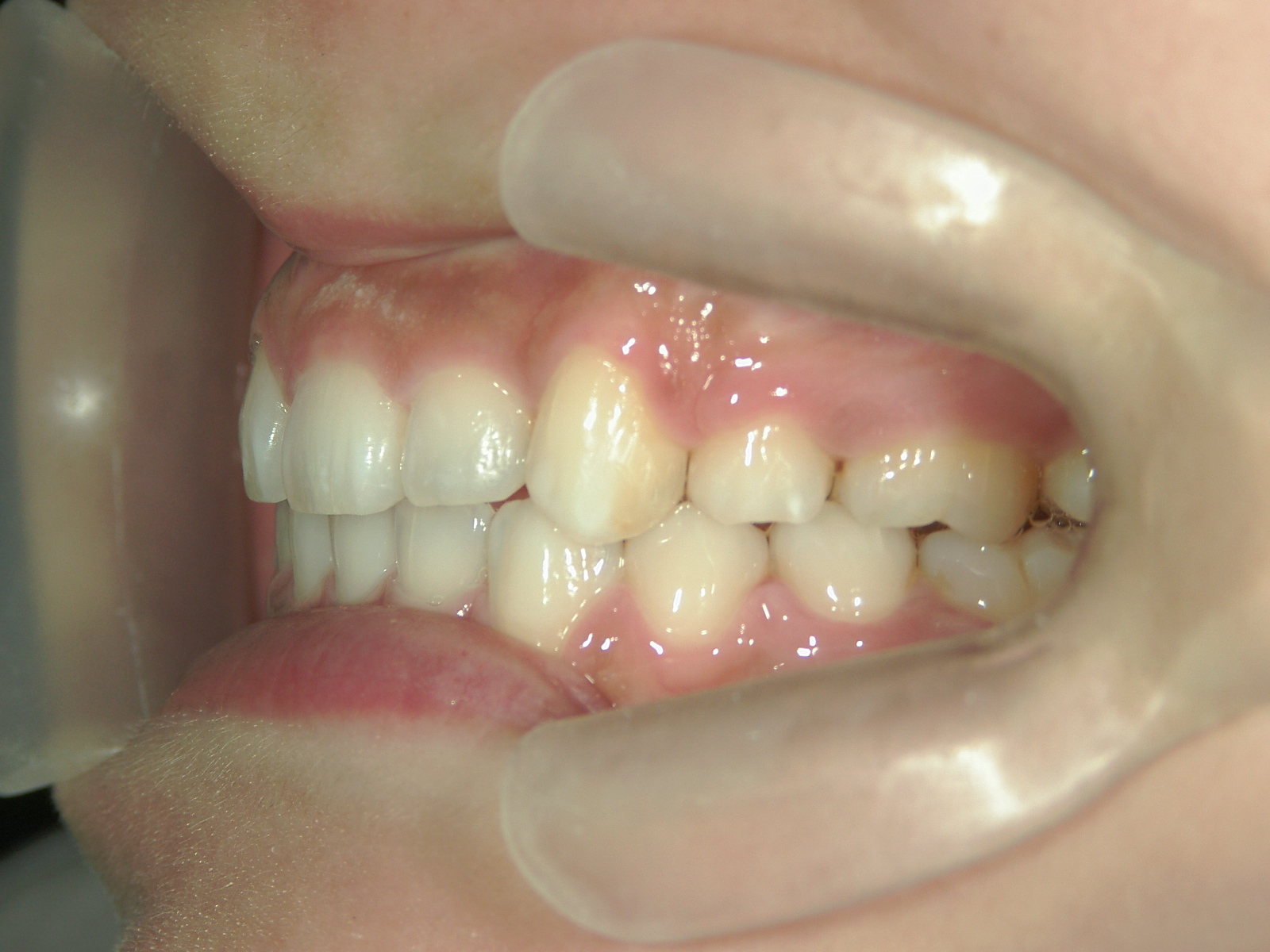 舌側ワイヤー矯正　症例（26）