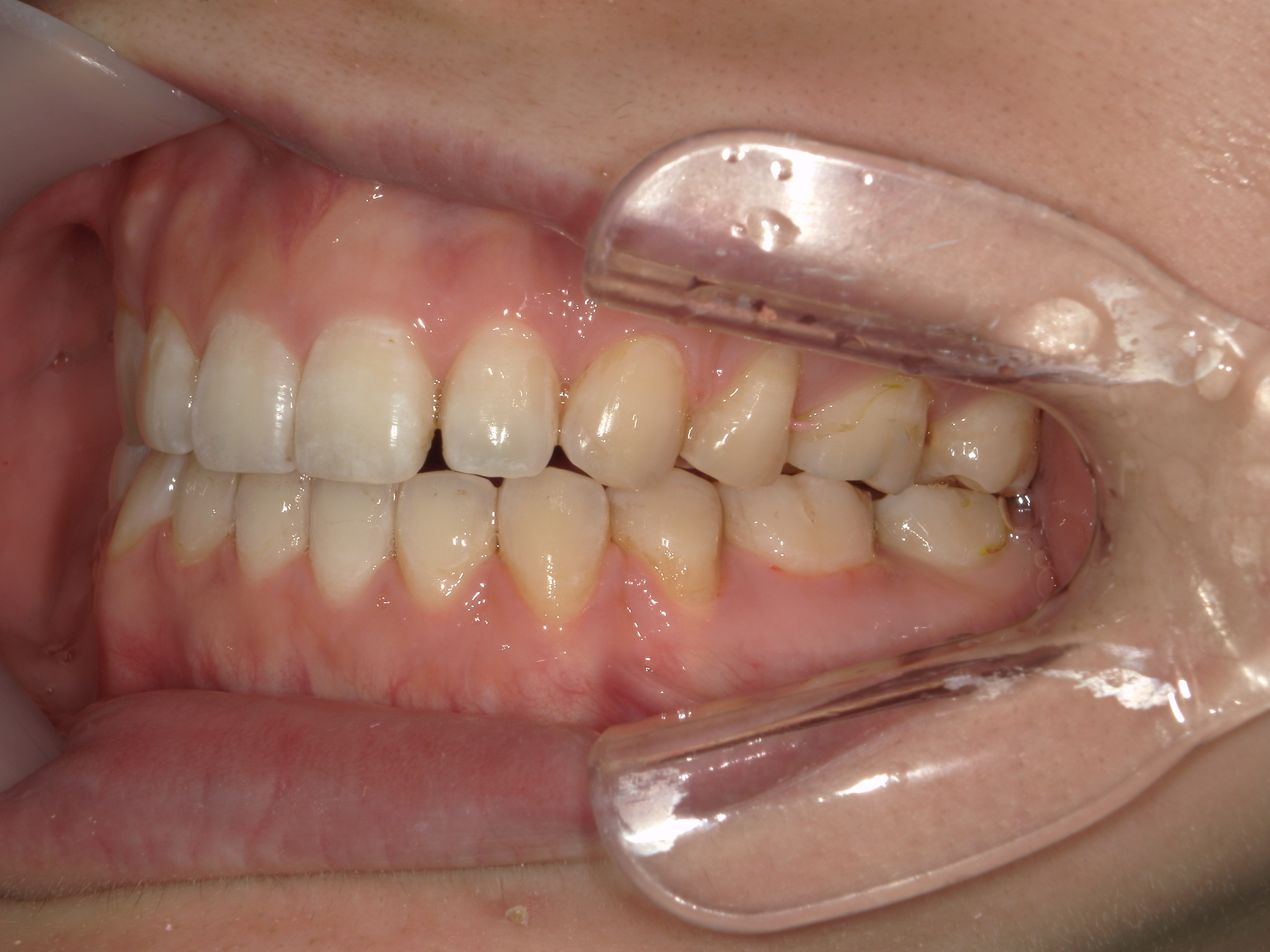 舌側ワイヤー矯正　症例（28）