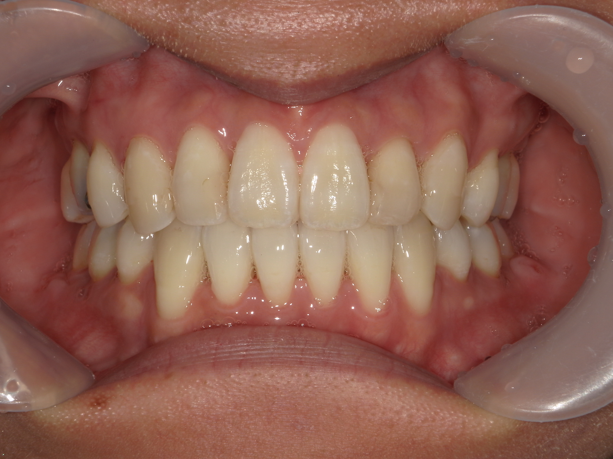 舌側ワイヤー矯正　症例（30）