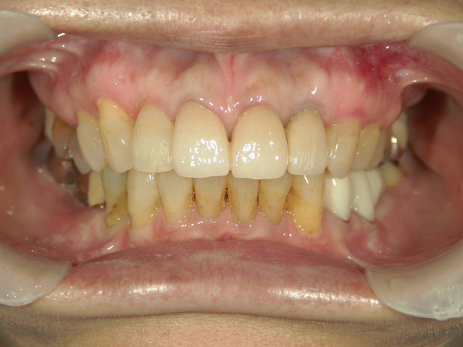 補綴併用症例（2）