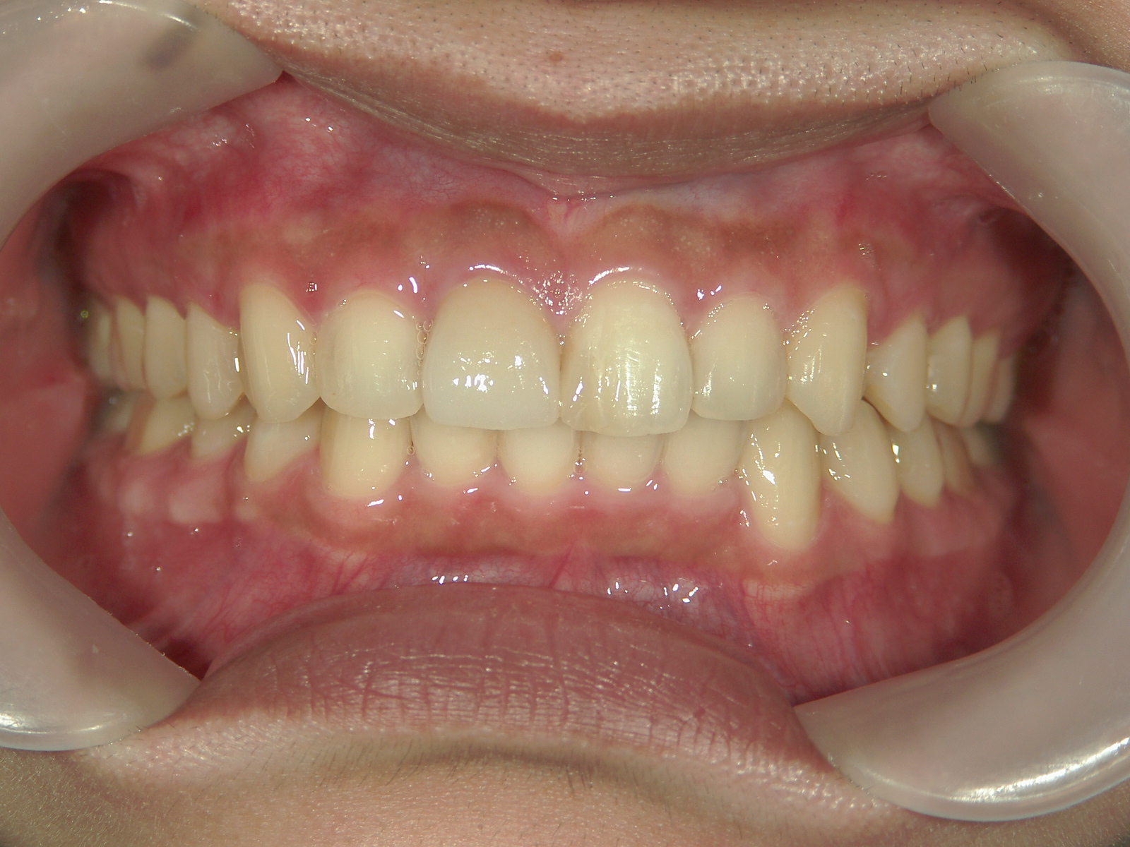 補綴併用症例（3）