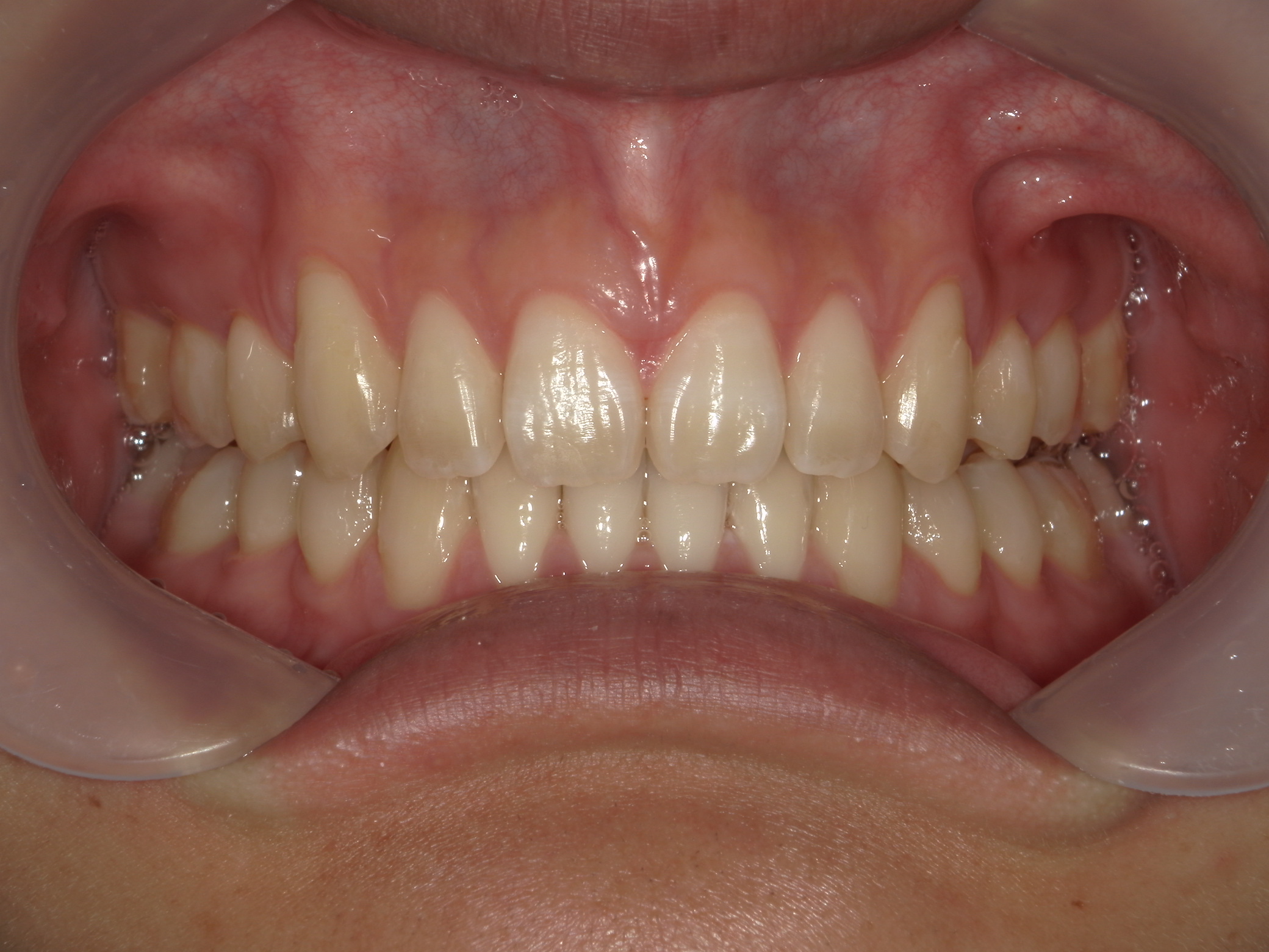 インビザライン矯正　症例（24）