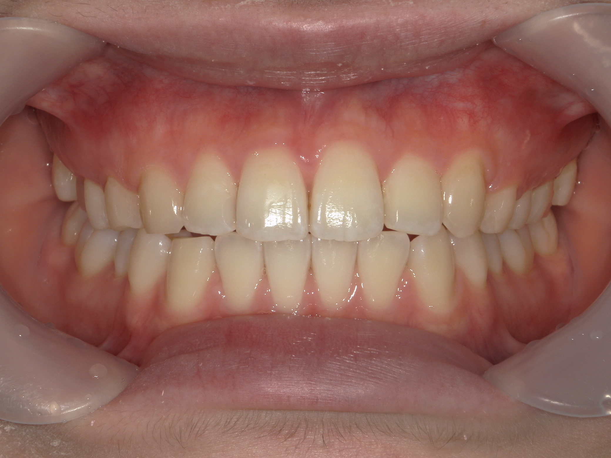 インビザライン矯正　症例（22）