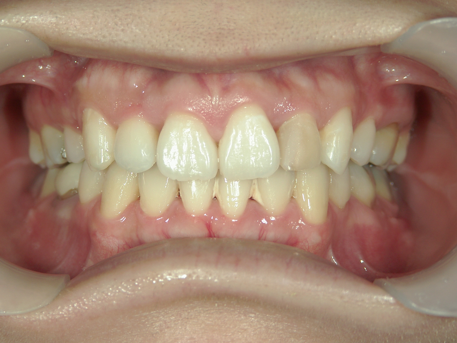 舌側ワイヤー矯正　症例（25）