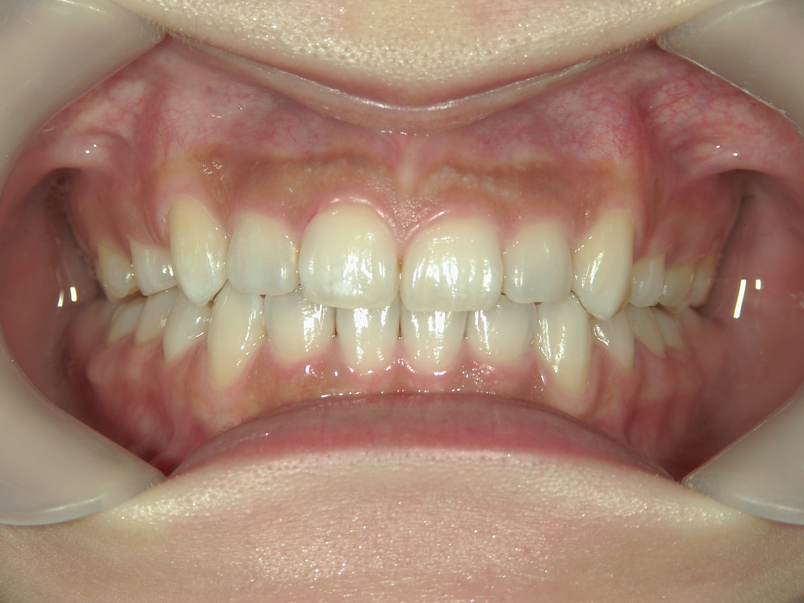 舌側ワイヤー矯正　症例（26）