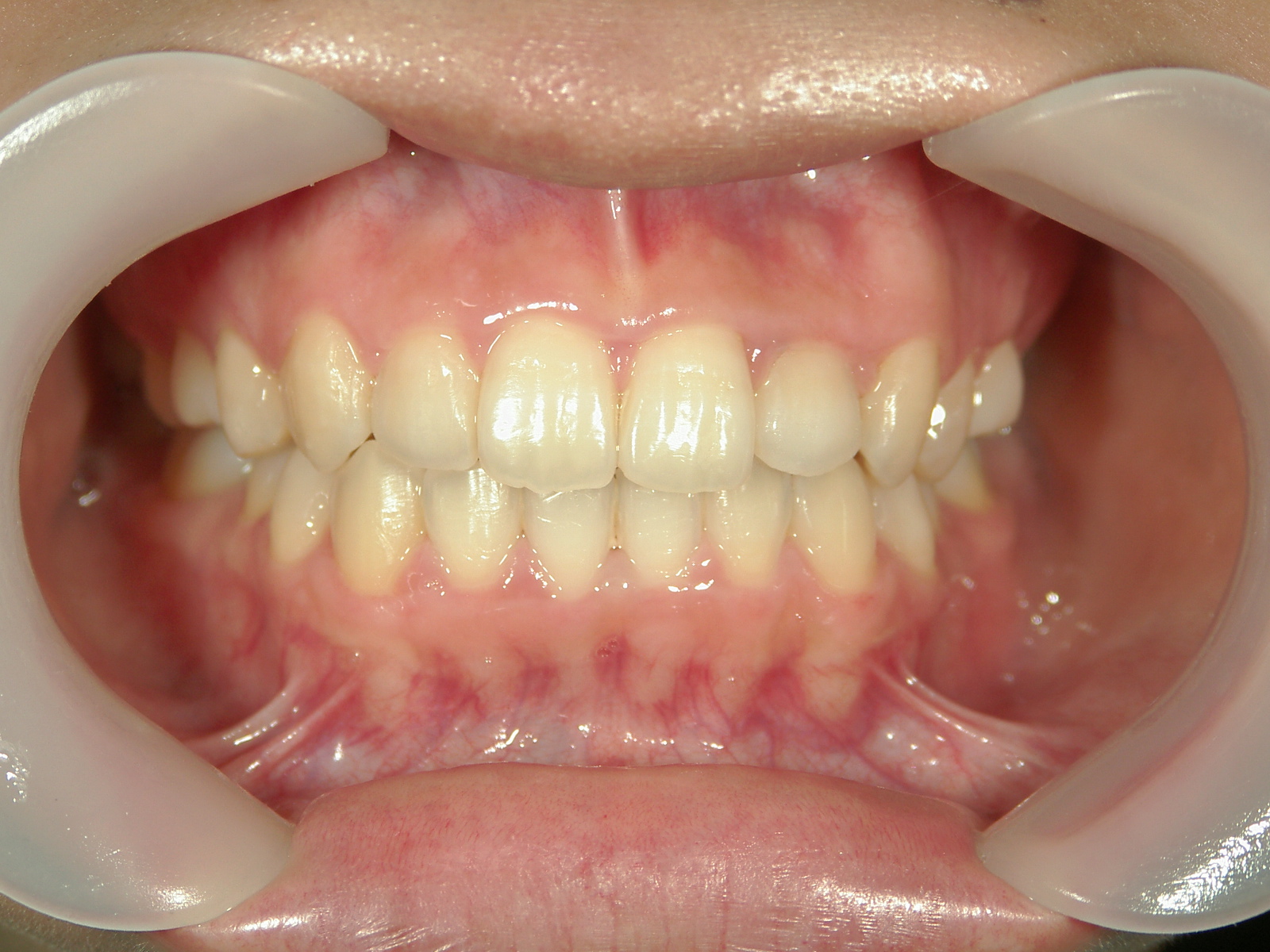 プチ舌側ワイヤー矯正　症例（27）