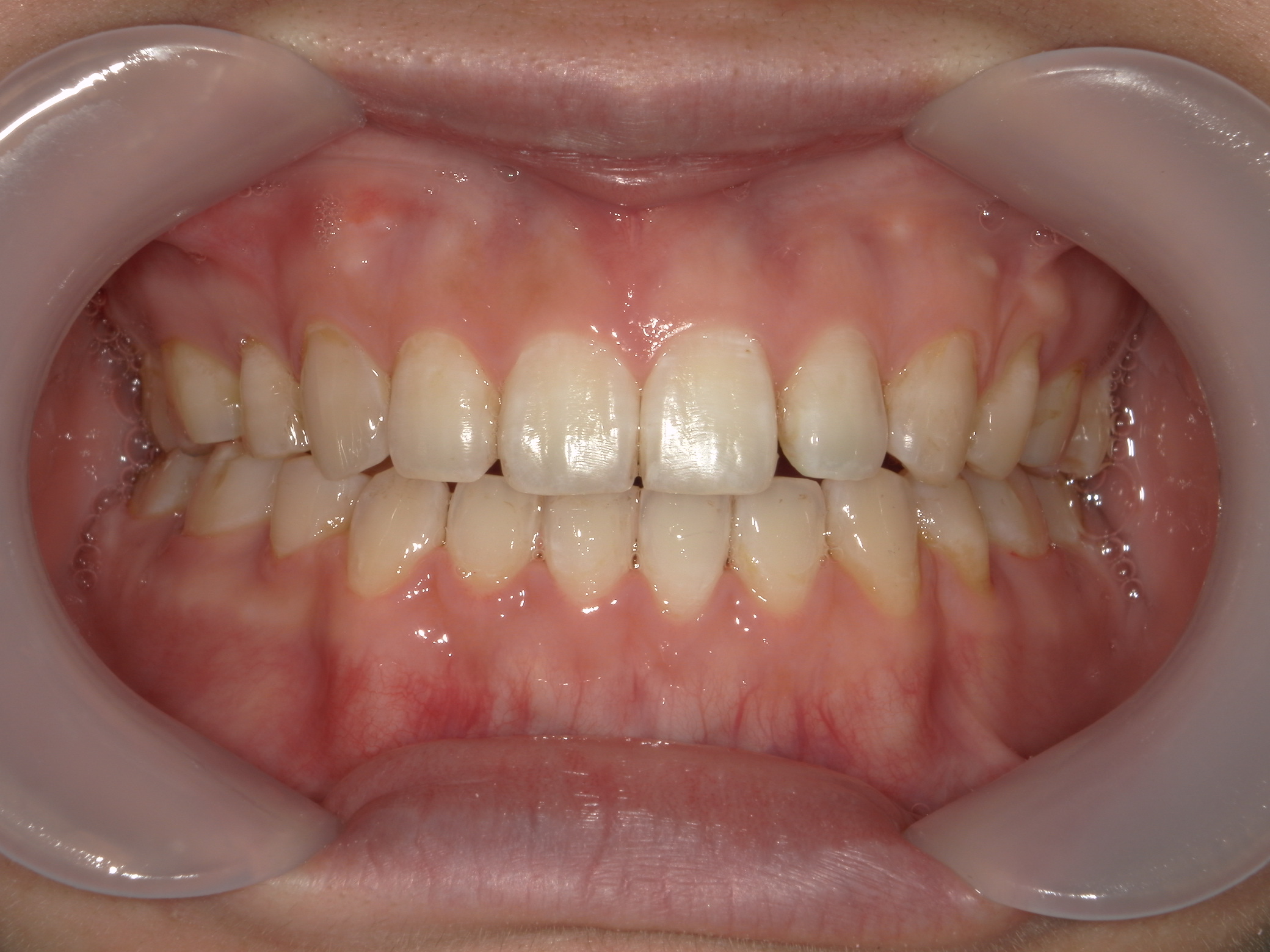 舌側ワイヤー矯正　症例（28）