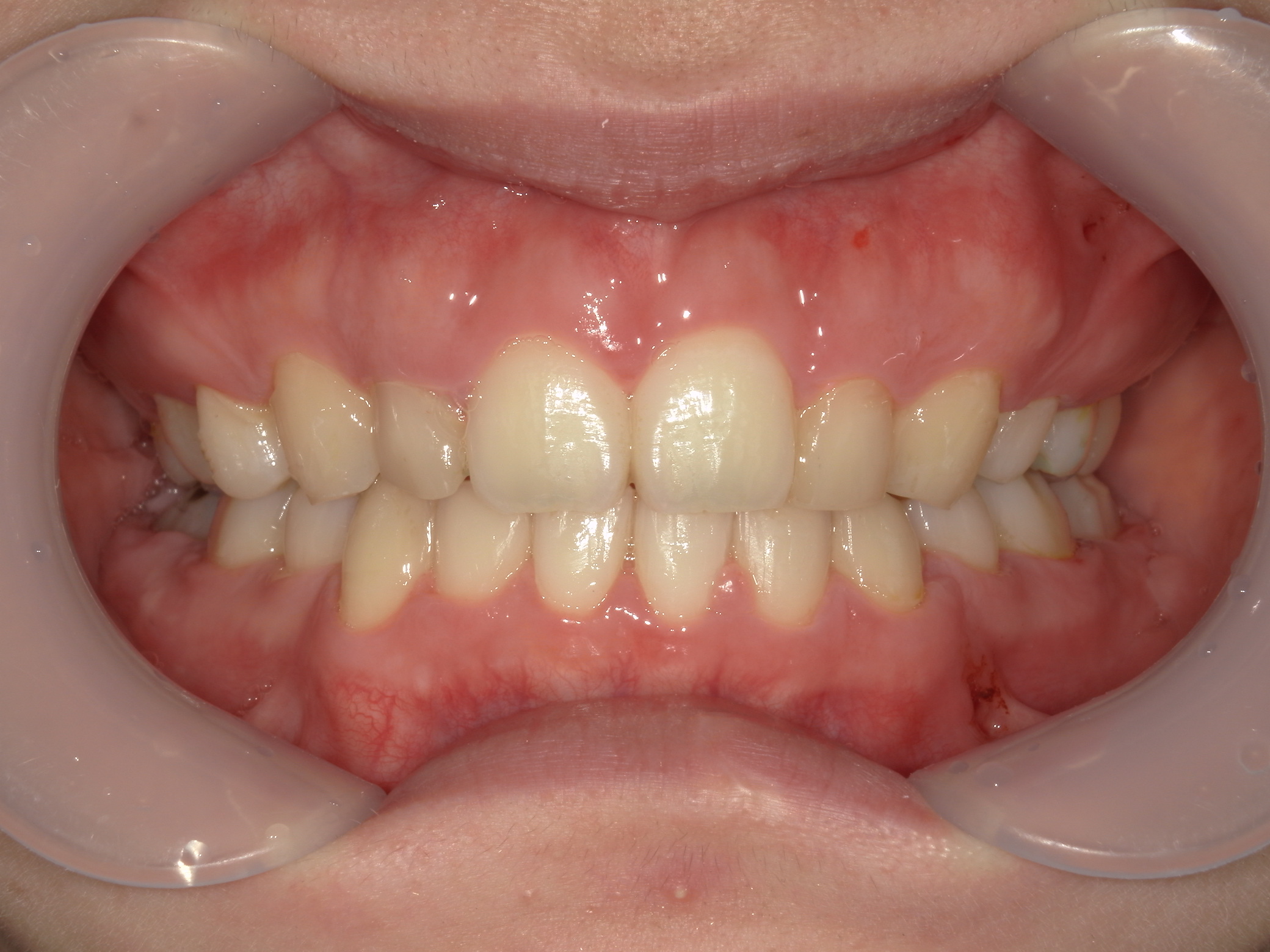 舌側ワイヤー矯正　症例（29）