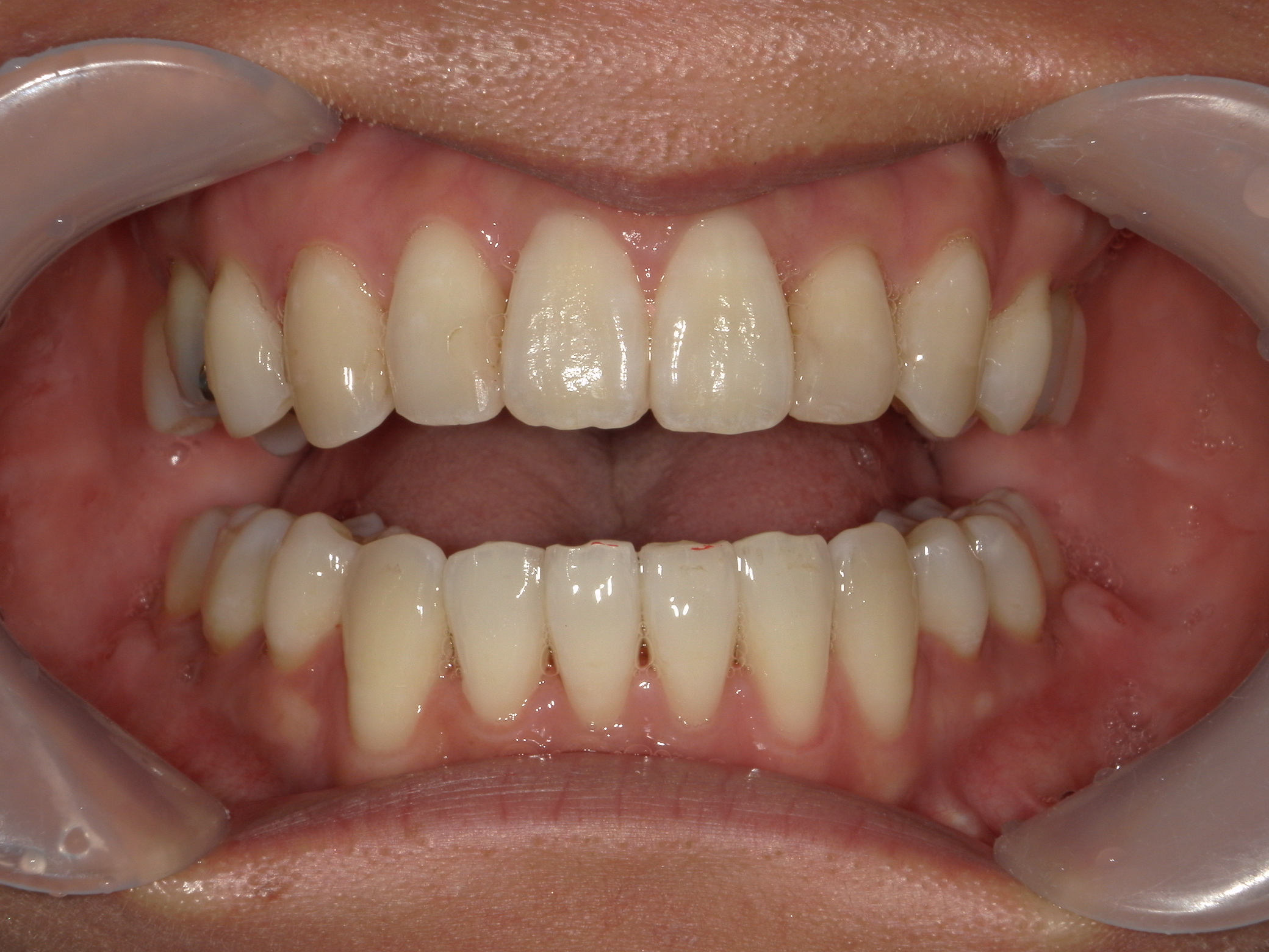 舌側ワイヤー矯正　症例（30）