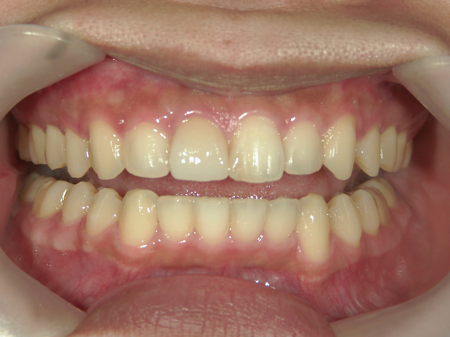 補綴併用症例（3）