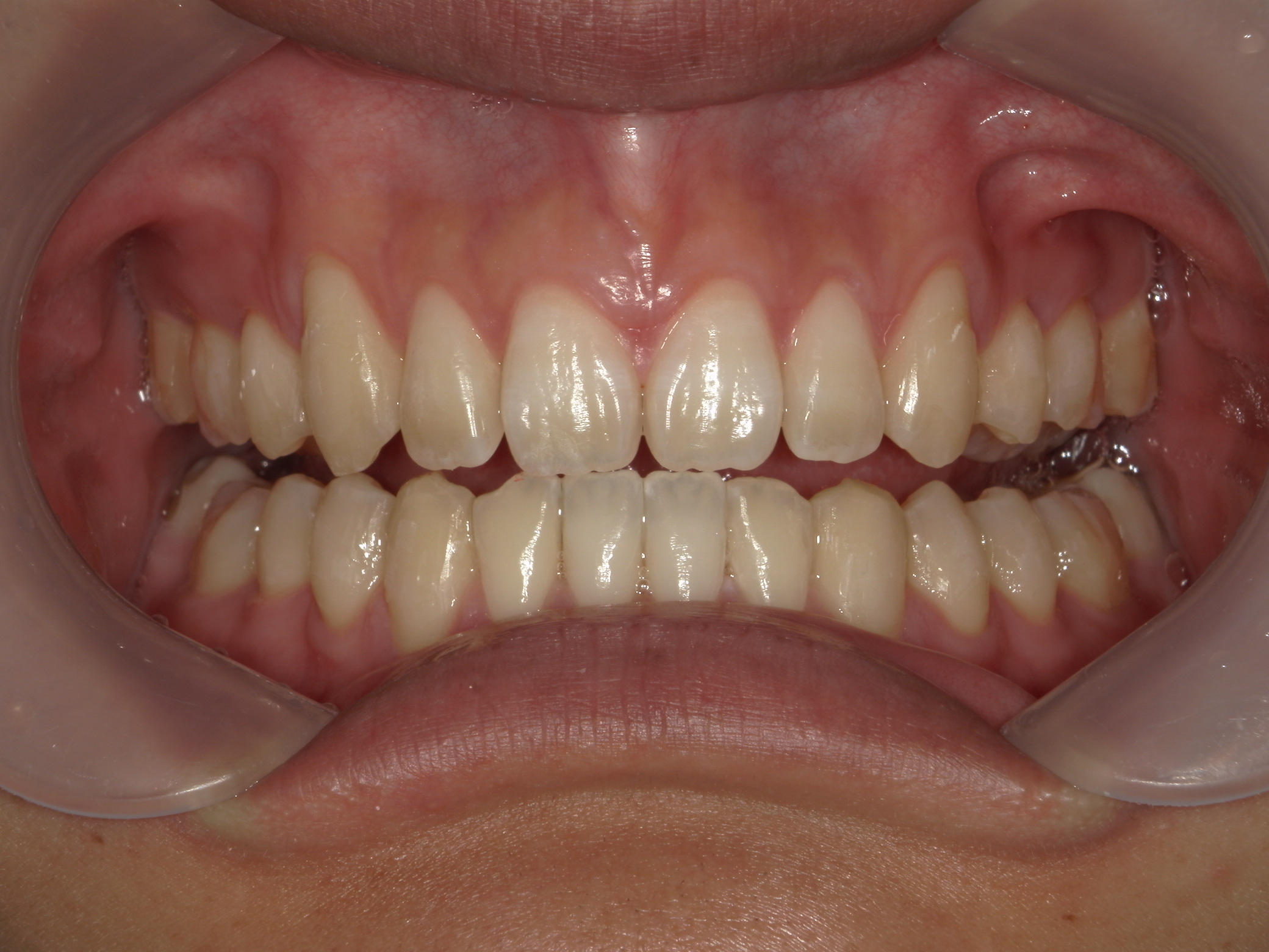 インビザライン矯正　症例（24）