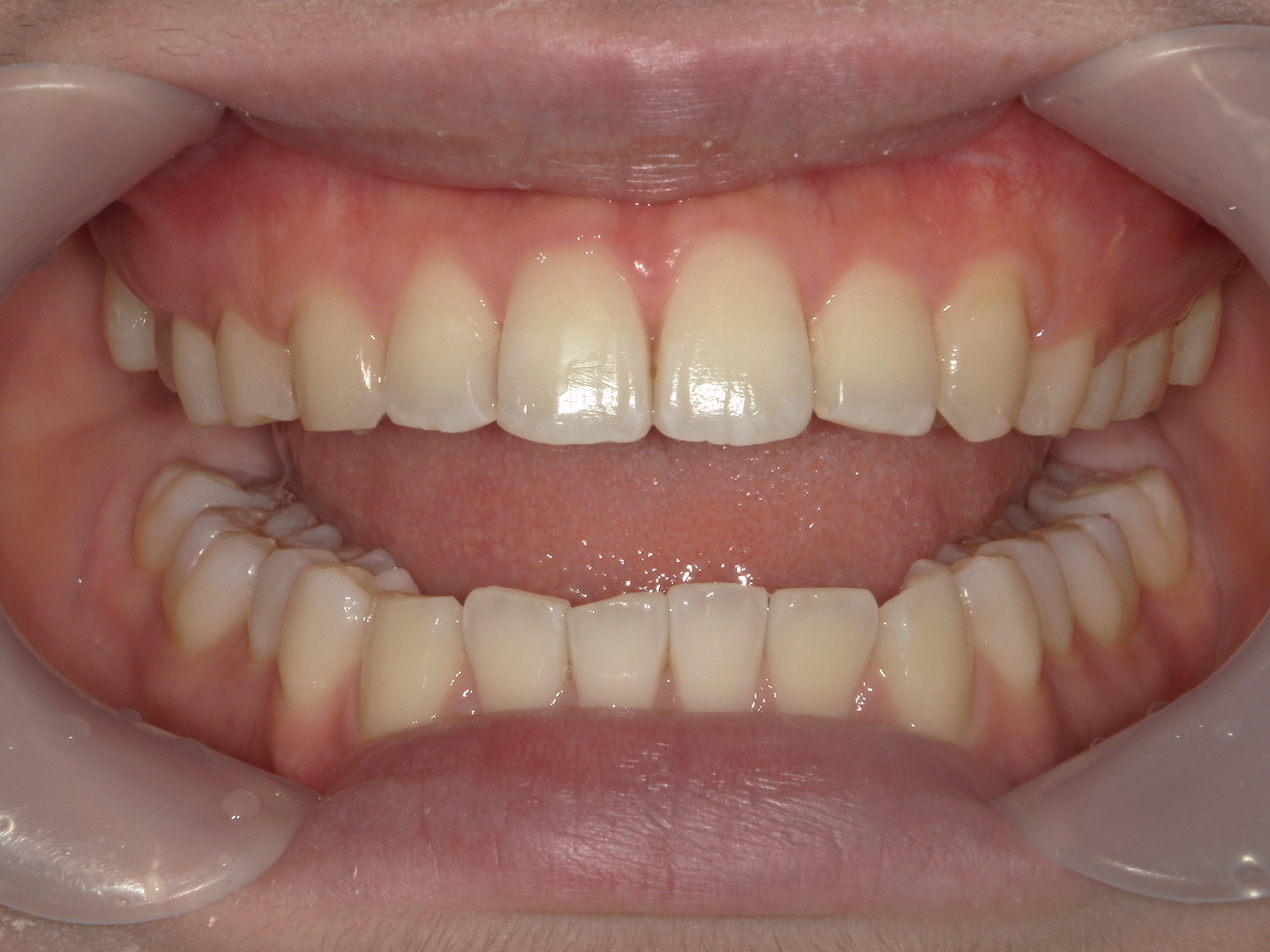 インビザライン矯正　症例（22）