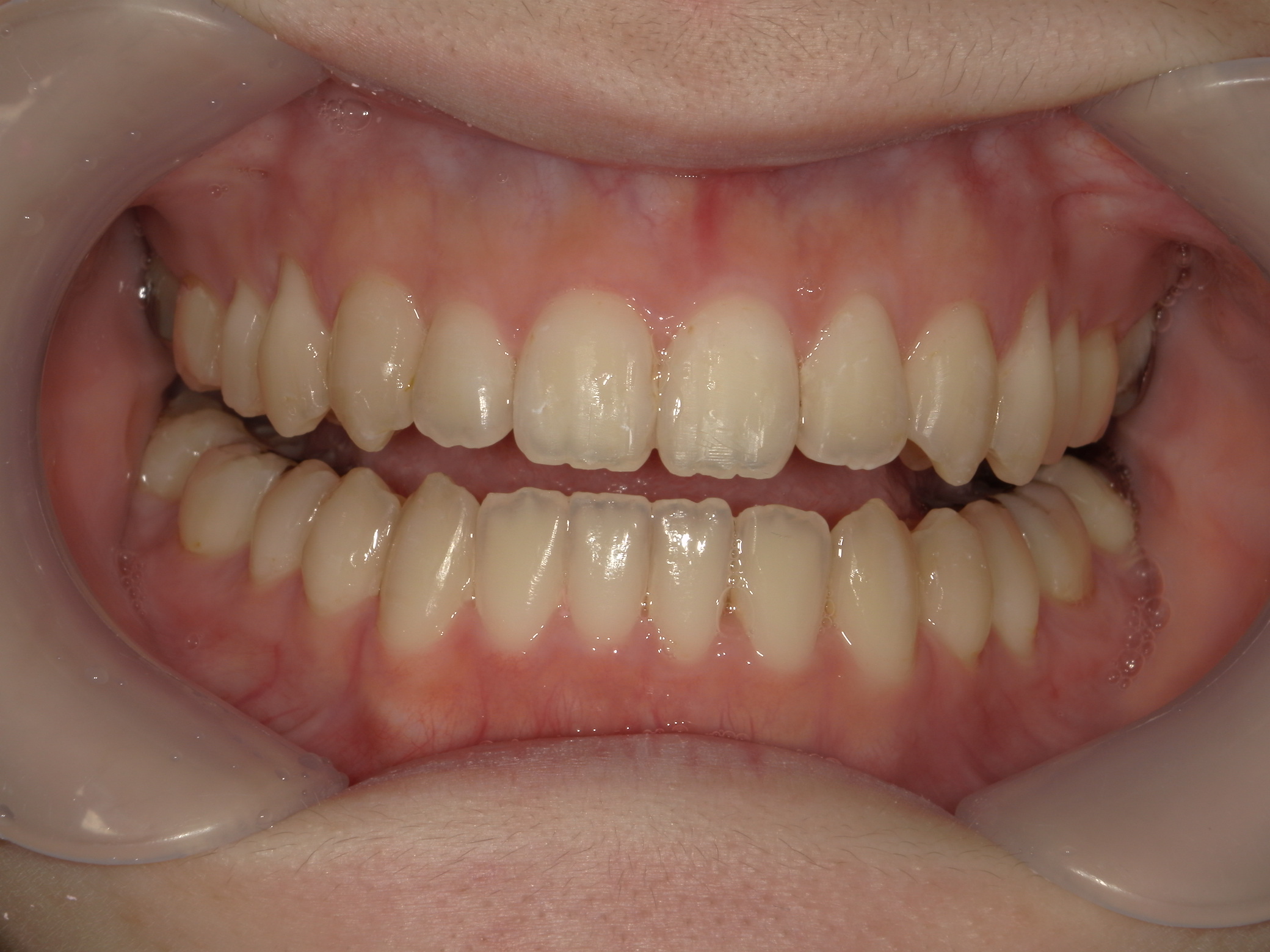 インビザライン矯正　症例（23）