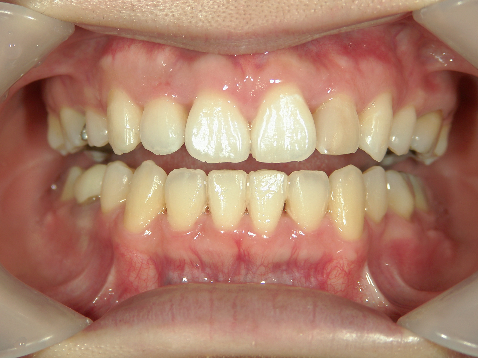 舌側ワイヤー矯正　症例（25）