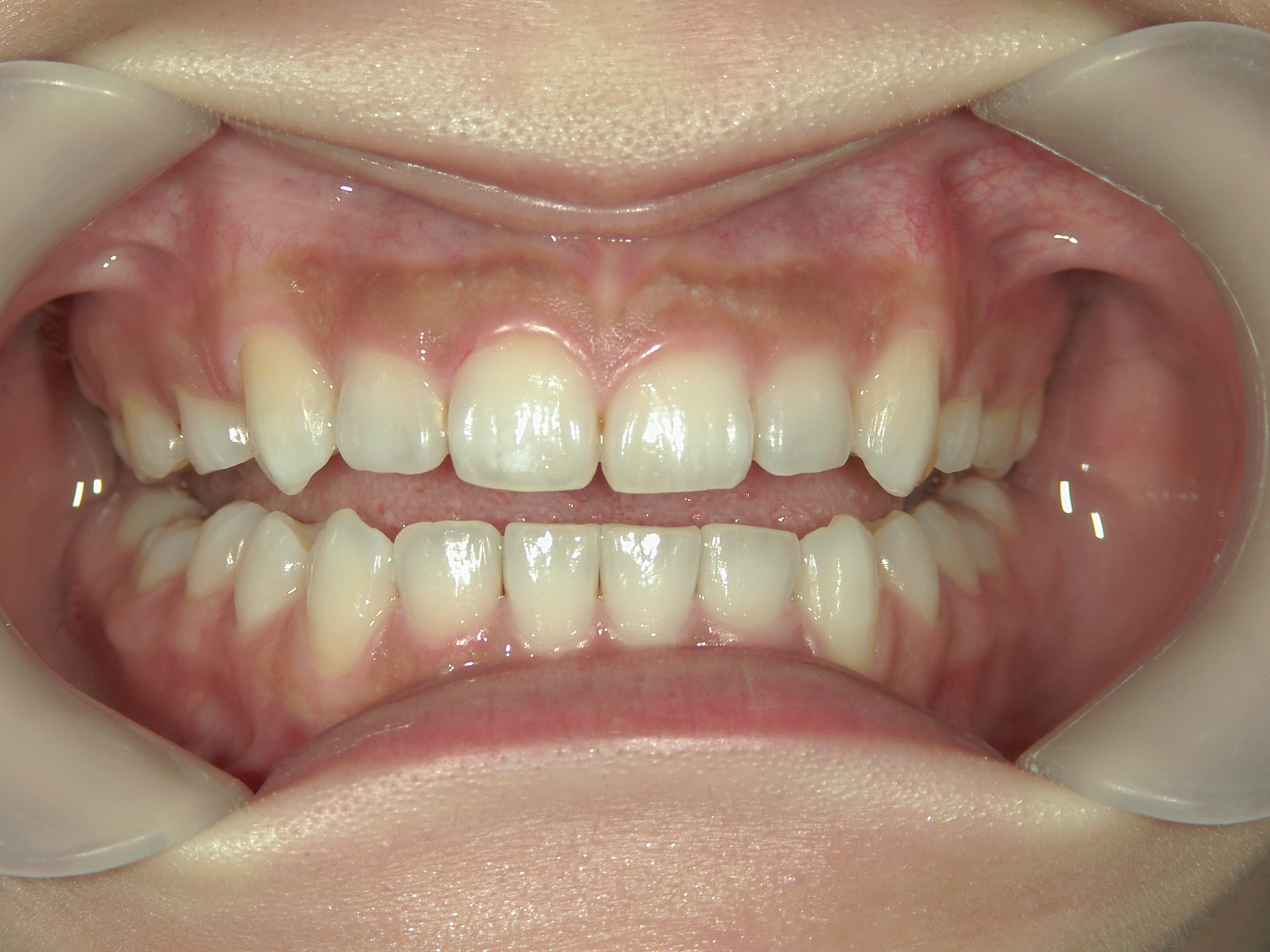 舌側ワイヤー矯正　症例（26）