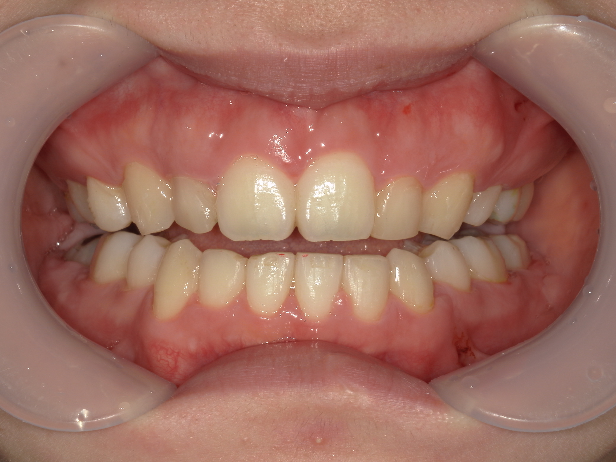 舌側ワイヤー矯正　症例（29）