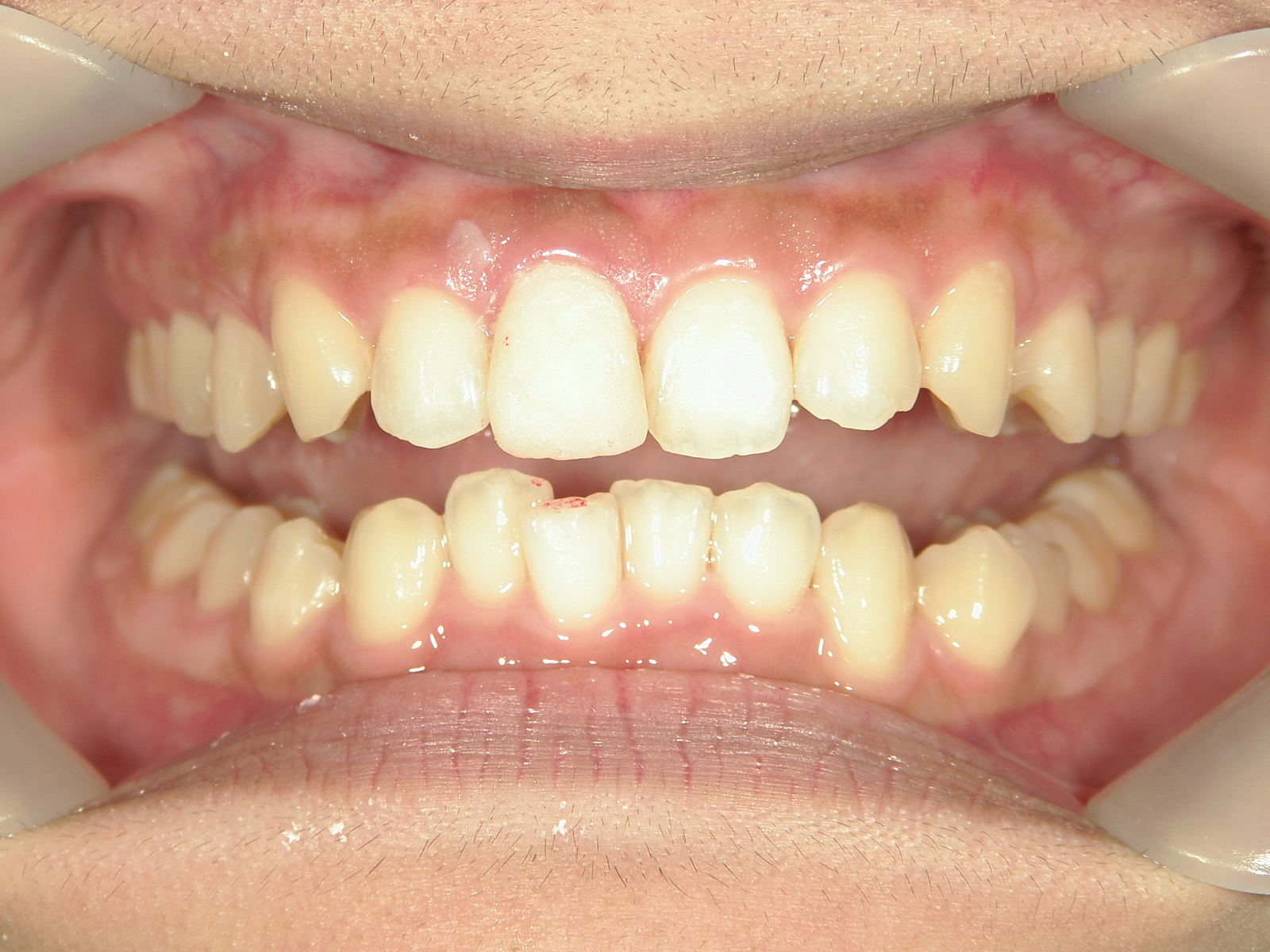 補綴併用症例（3）