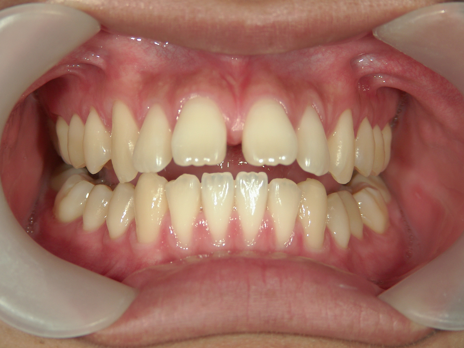 インビザライン矯正　症例（24）