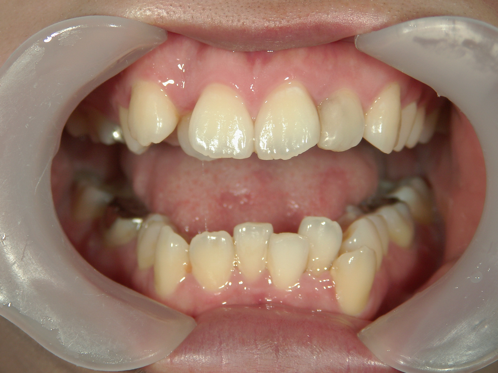 舌側ワイヤー矯正　症例（25）