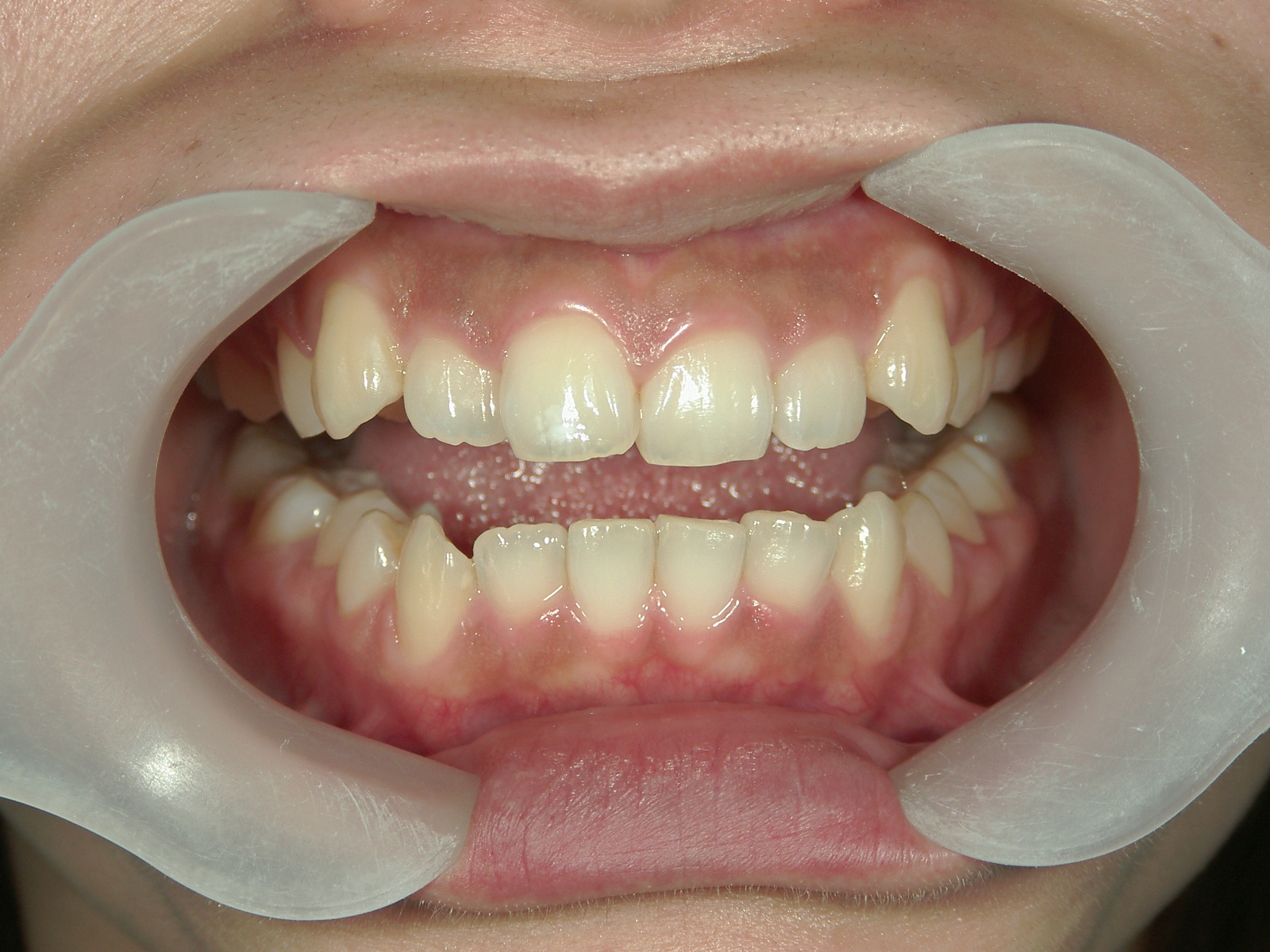 舌側ワイヤー矯正　症例（26）