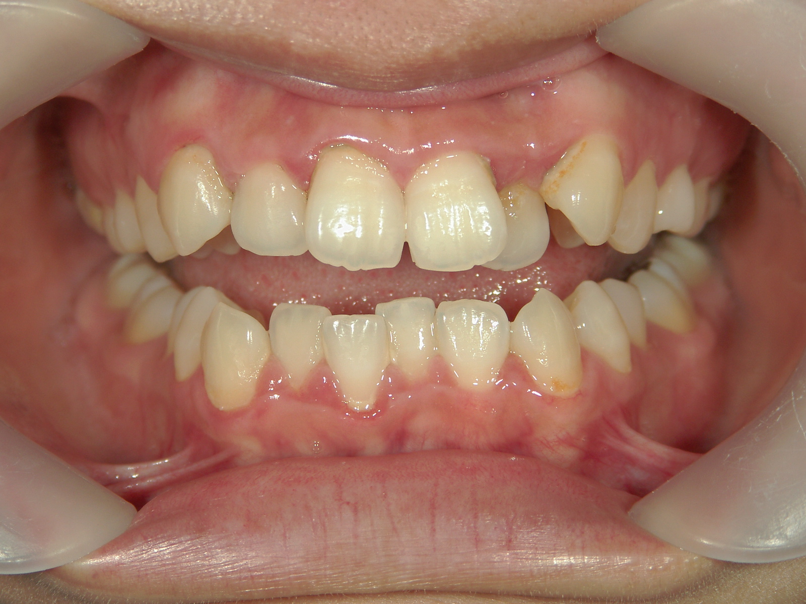 プチ舌側ワイヤー矯正　症例（27）