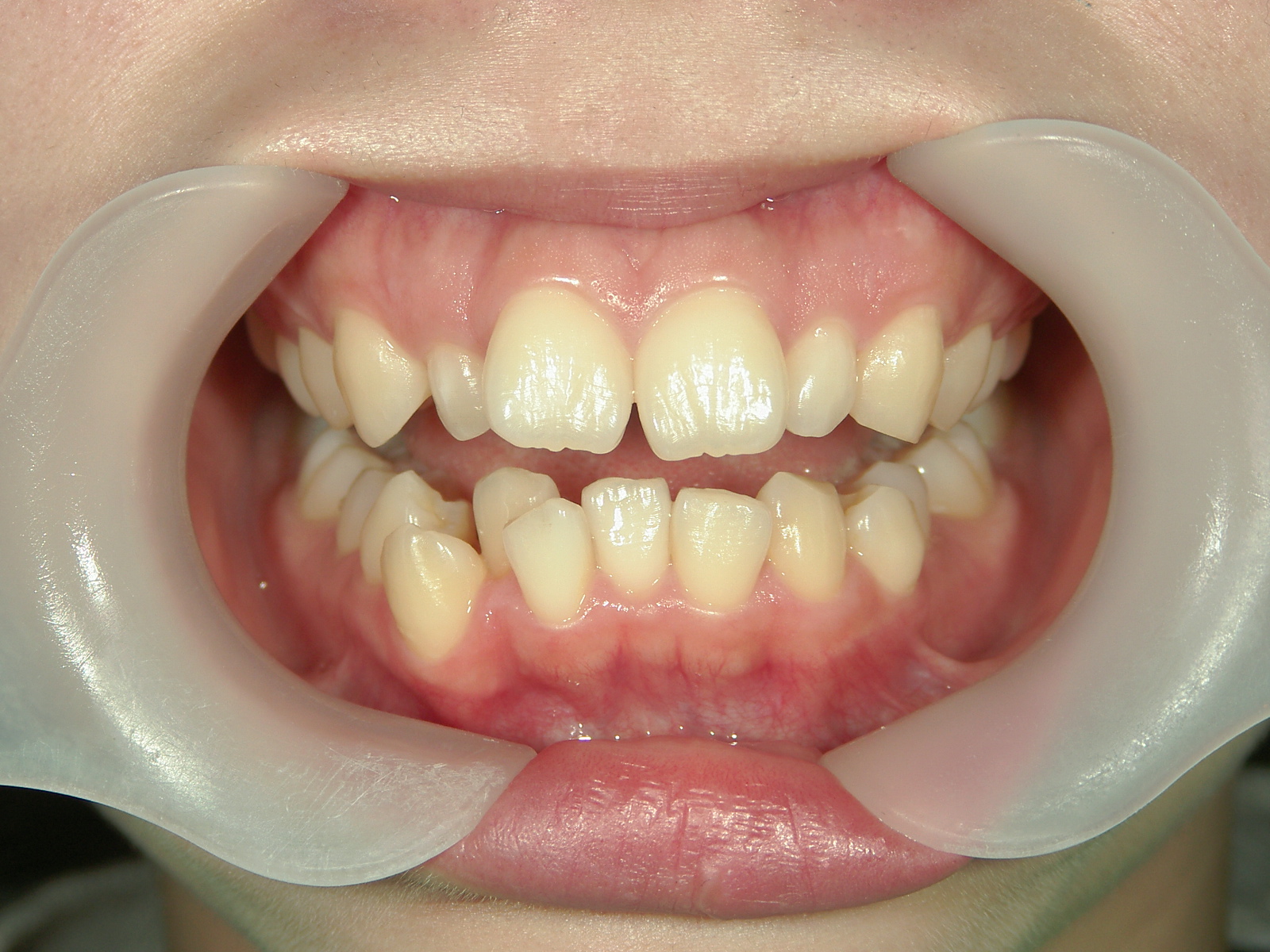 舌側ワイヤー矯正　症例（29）