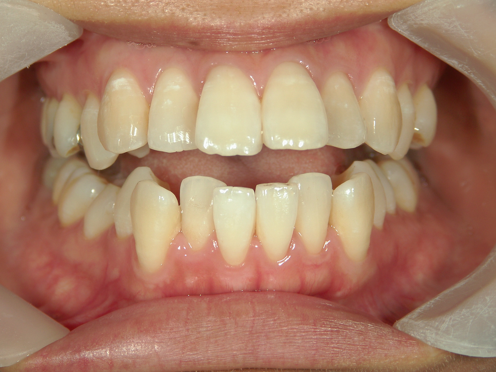 舌側ワイヤー矯正　症例（30）