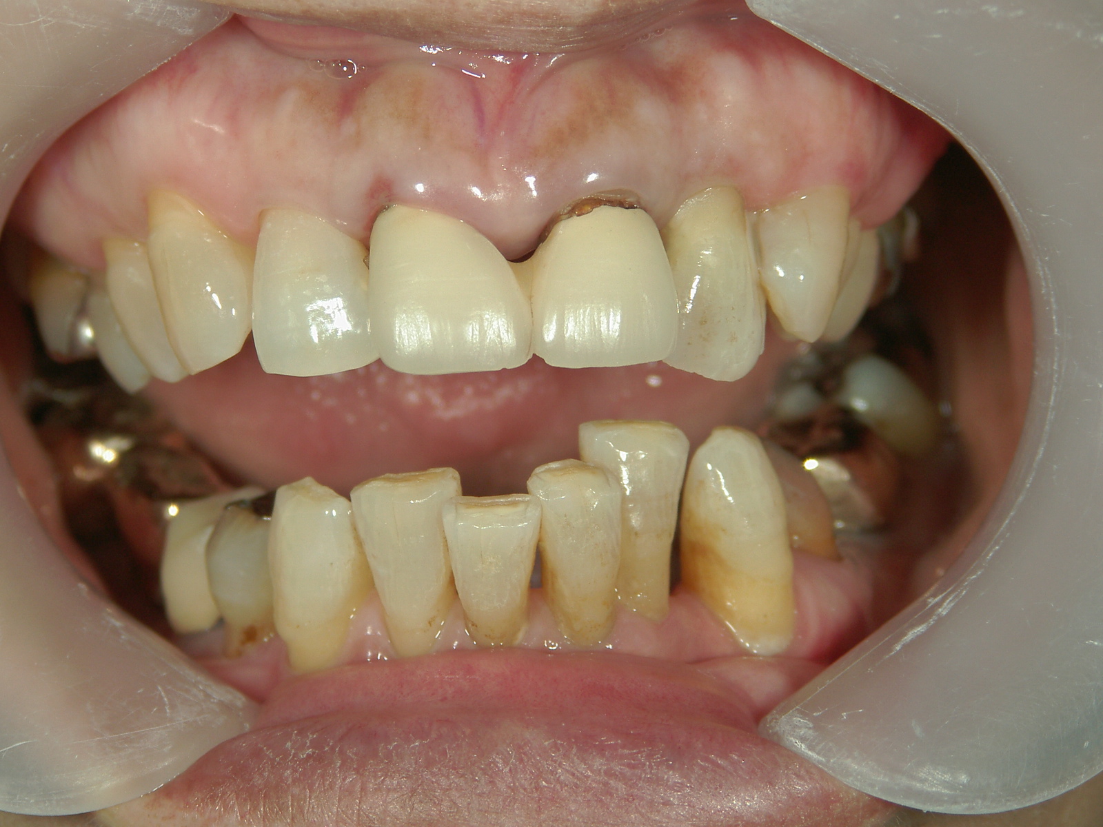 補綴併用症例（2）