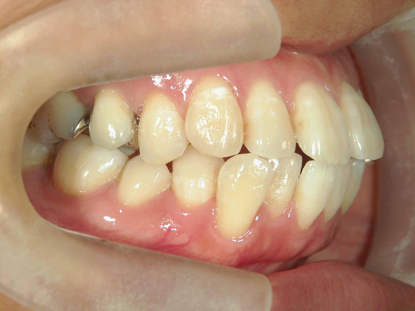 舌側ワイヤー矯正　症例（30）