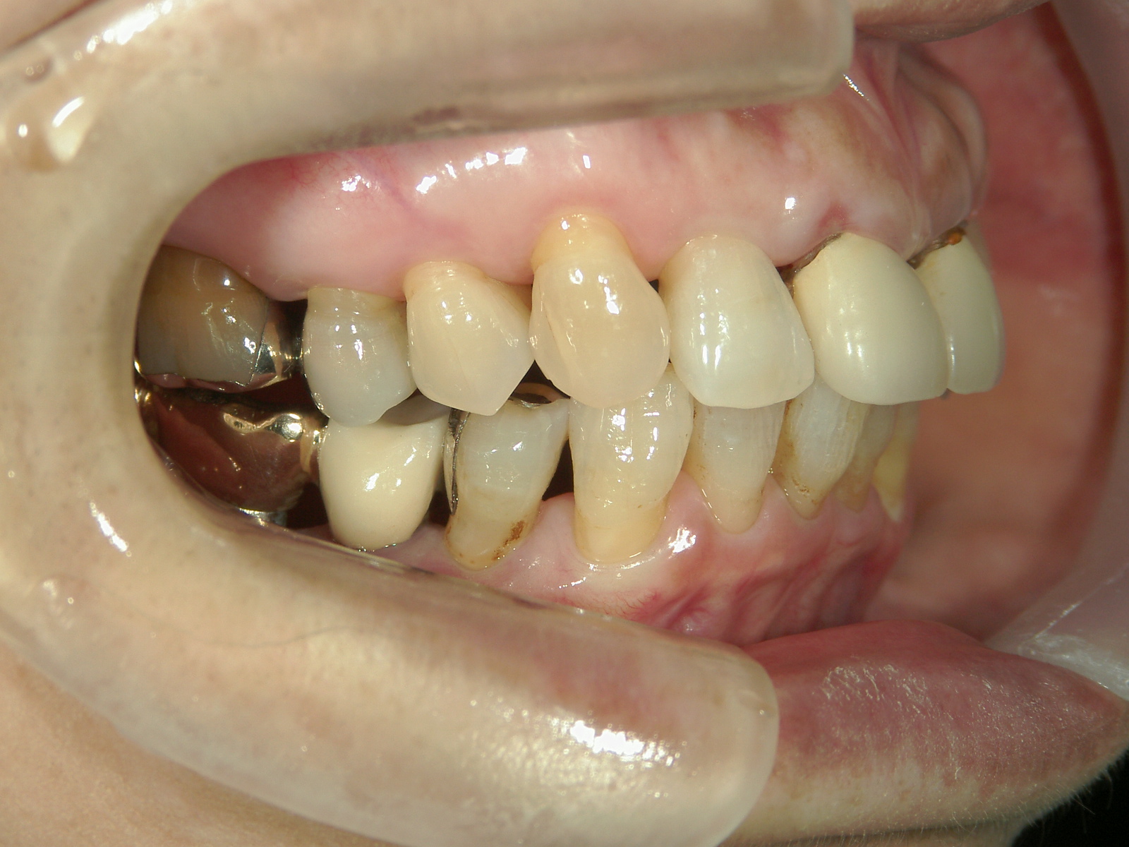 補綴併用症例（2）