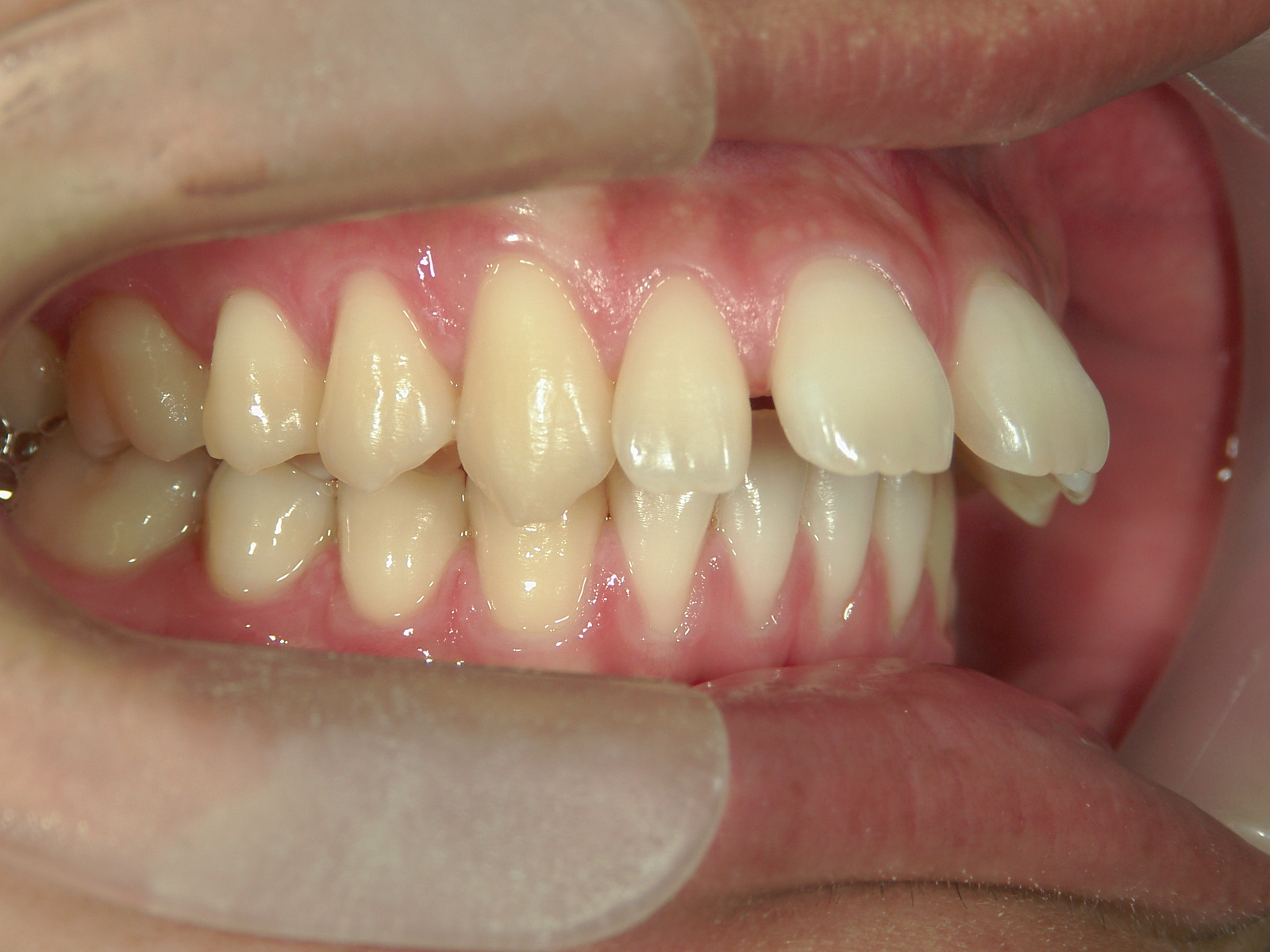 インビザライン矯正　症例（24）