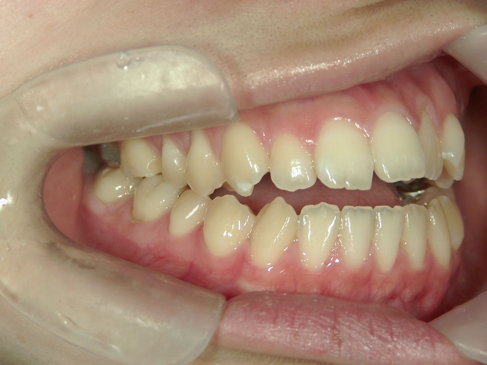 インビザライン矯正　症例（23）