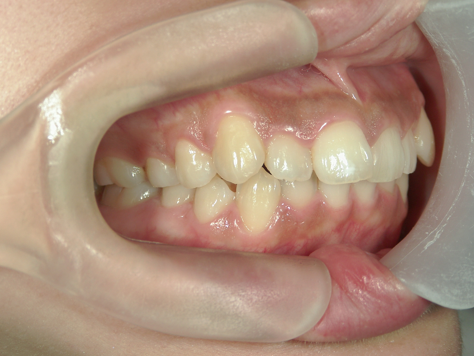 舌側ワイヤー矯正　症例（26）