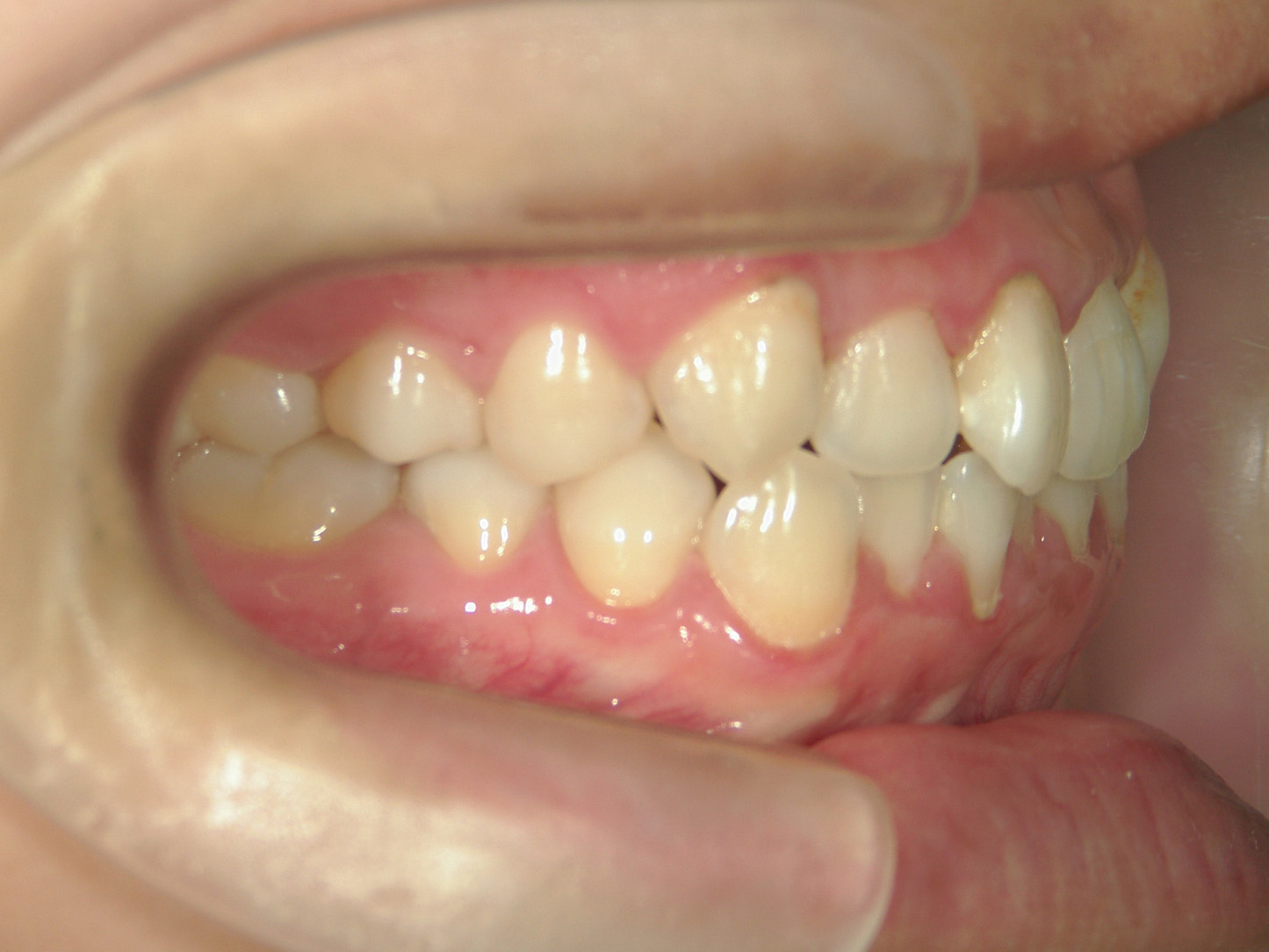 プチ舌側ワイヤー矯正　症例（27）