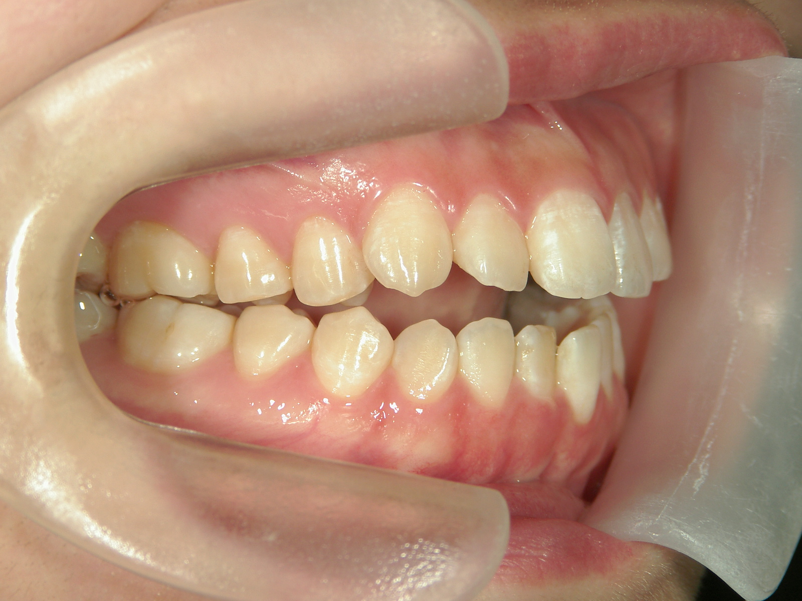 舌側ワイヤー矯正　症例（28）