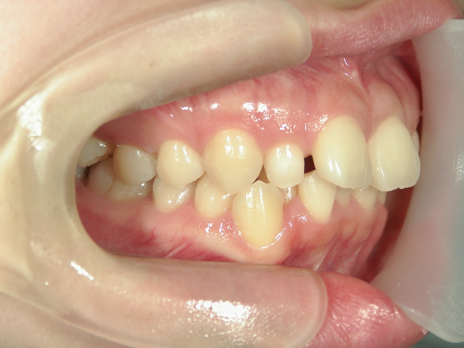 舌側ワイヤー矯正　症例（29）