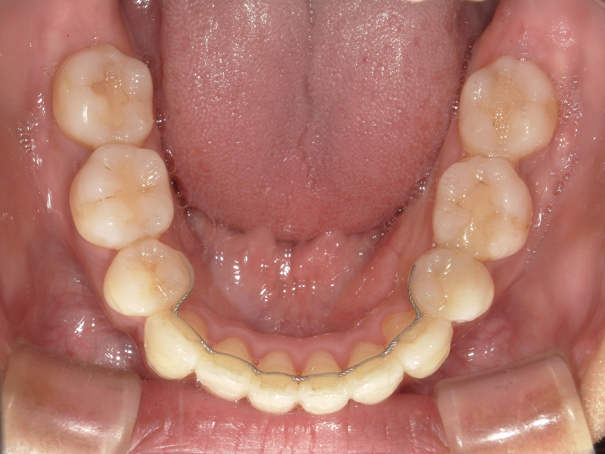 舌側ワイヤー矯正　症例（30）