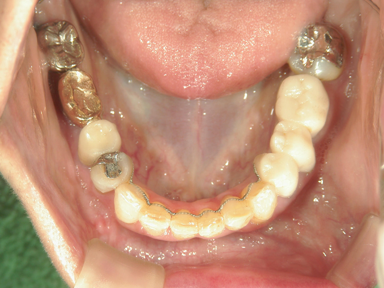 補綴併用症例（2）