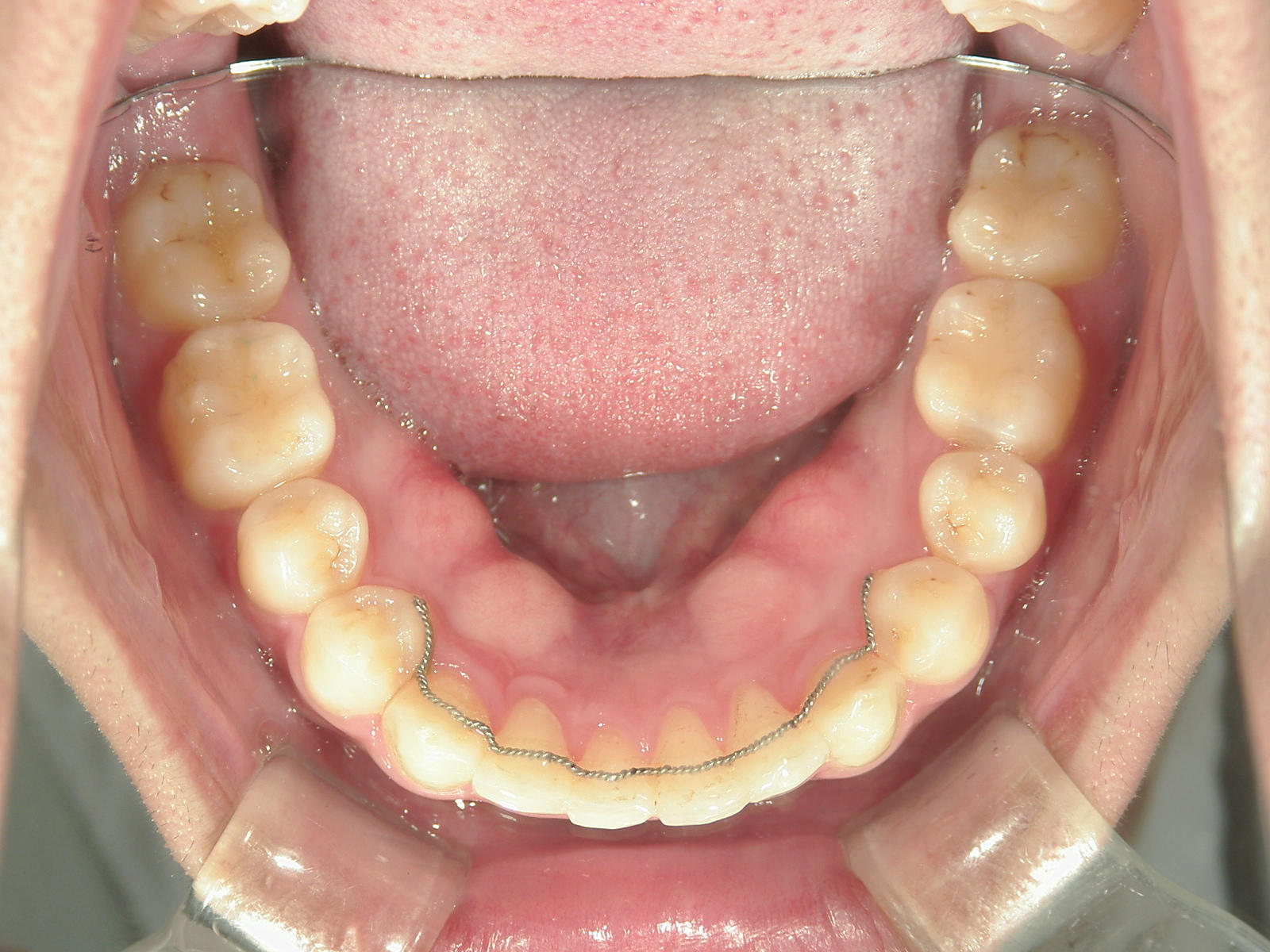 補綴併用症例（3）