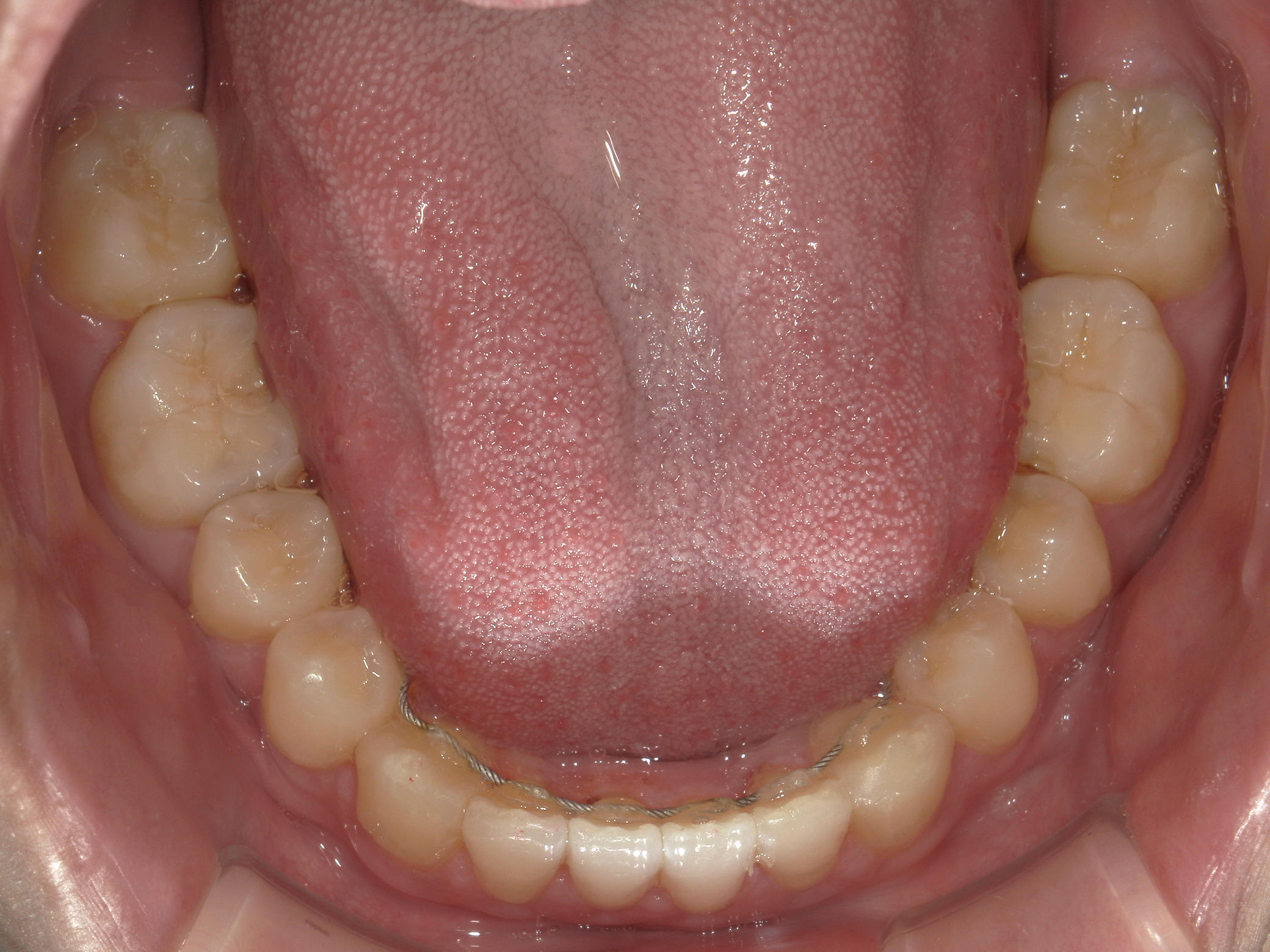 インビザライン矯正　症例（24）