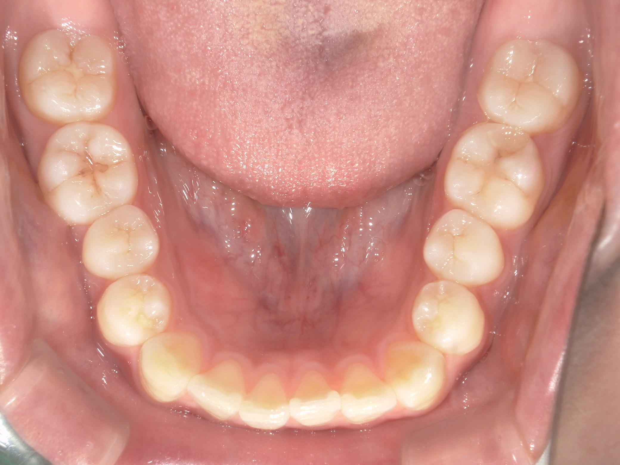 インビザライン矯正　症例（22）