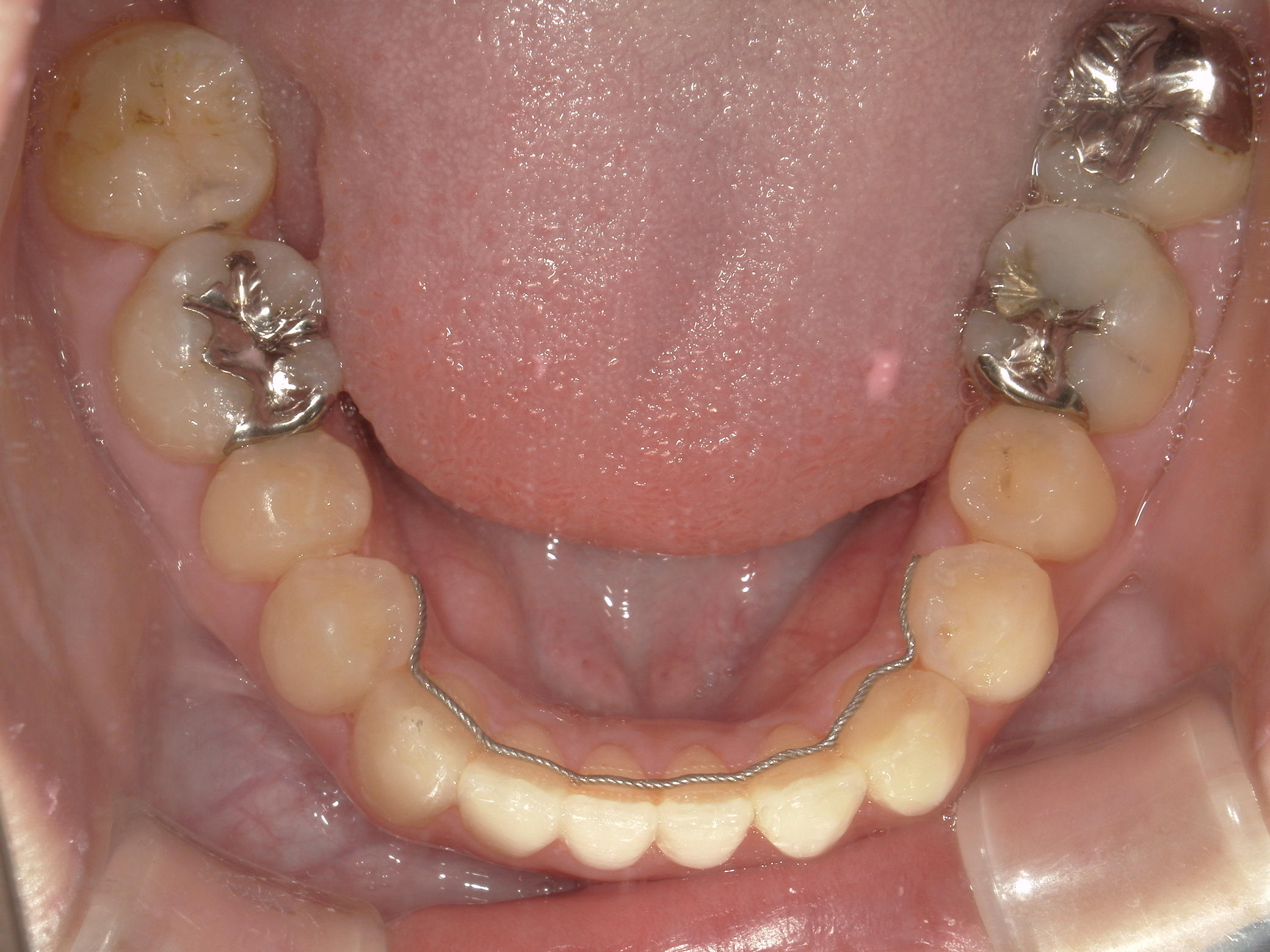 インビザライン矯正　症例（23）