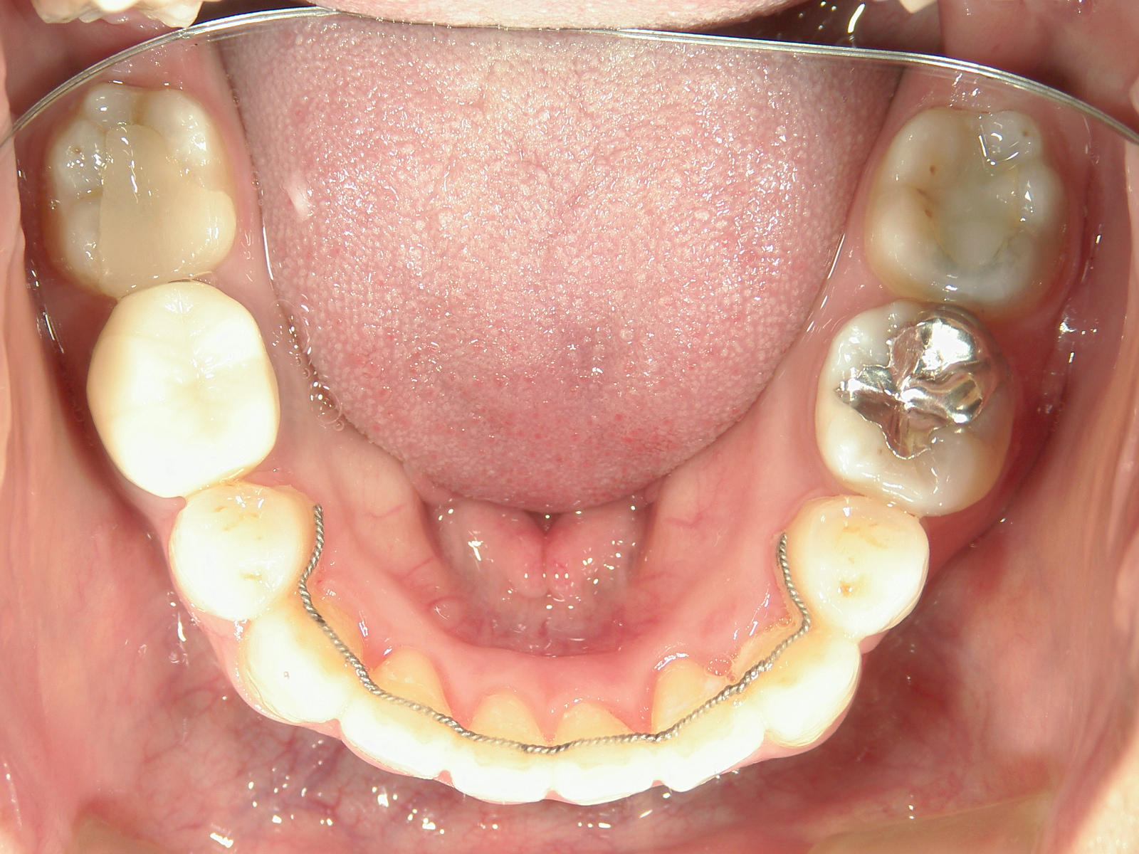 舌側ワイヤー矯正　症例（25）