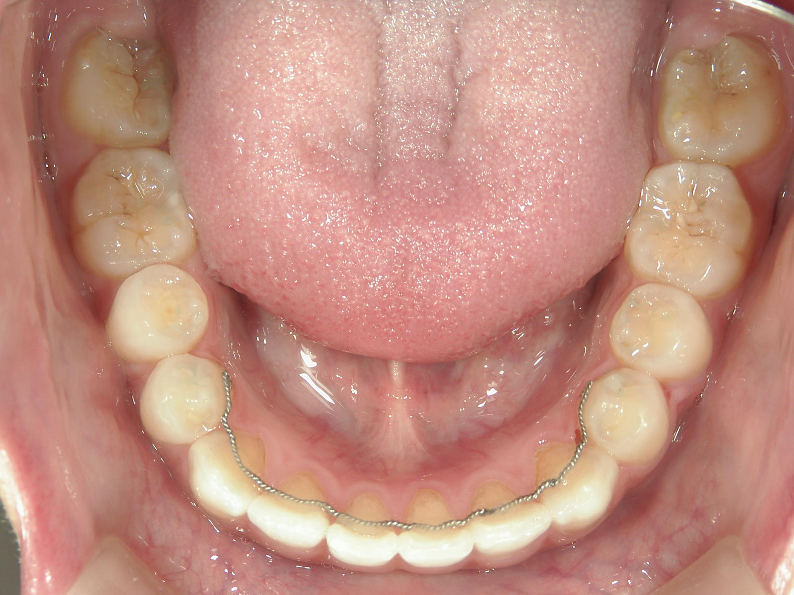 舌側ワイヤー矯正　症例（26）