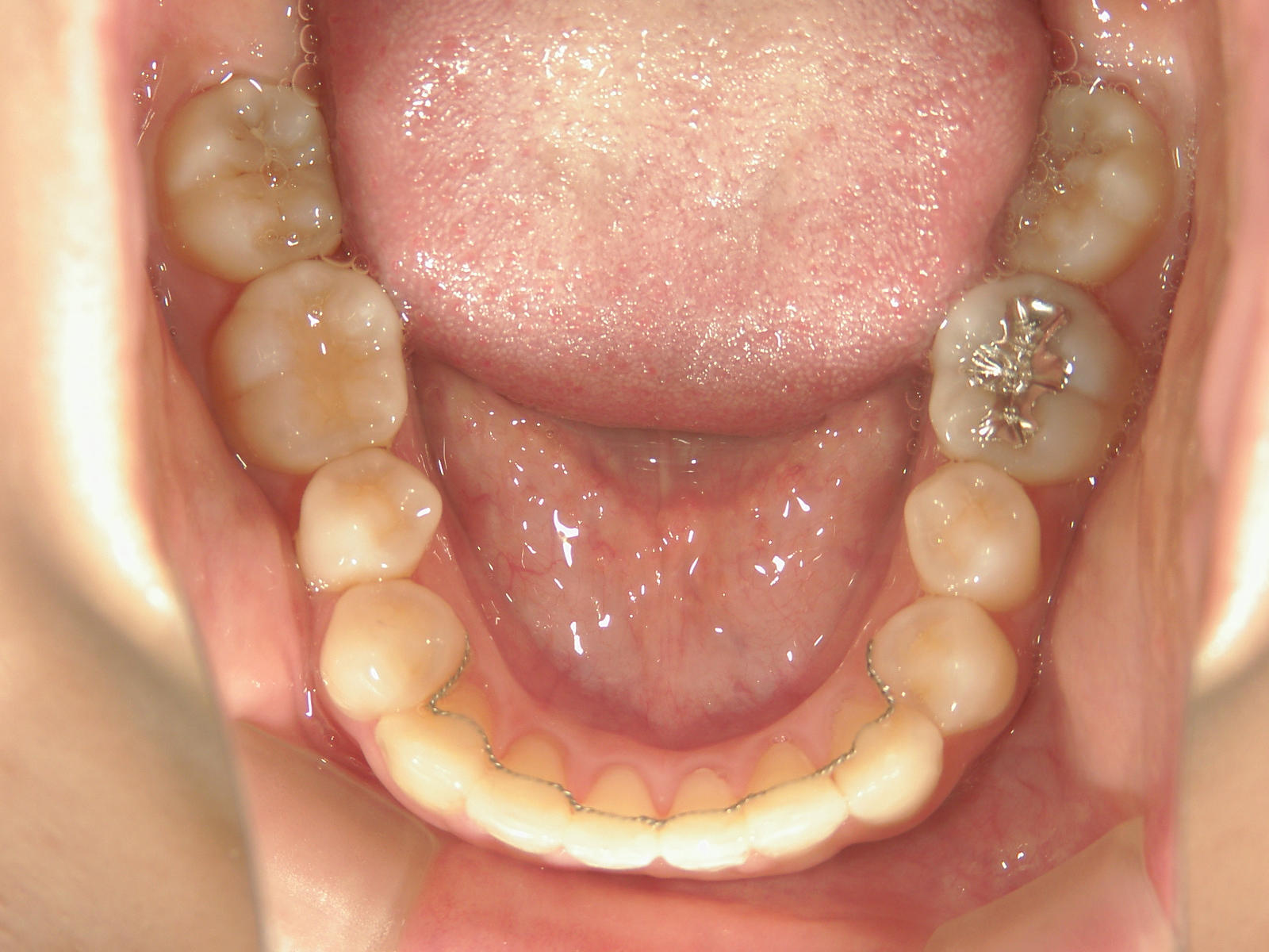 プチ舌側ワイヤー矯正　症例（27）