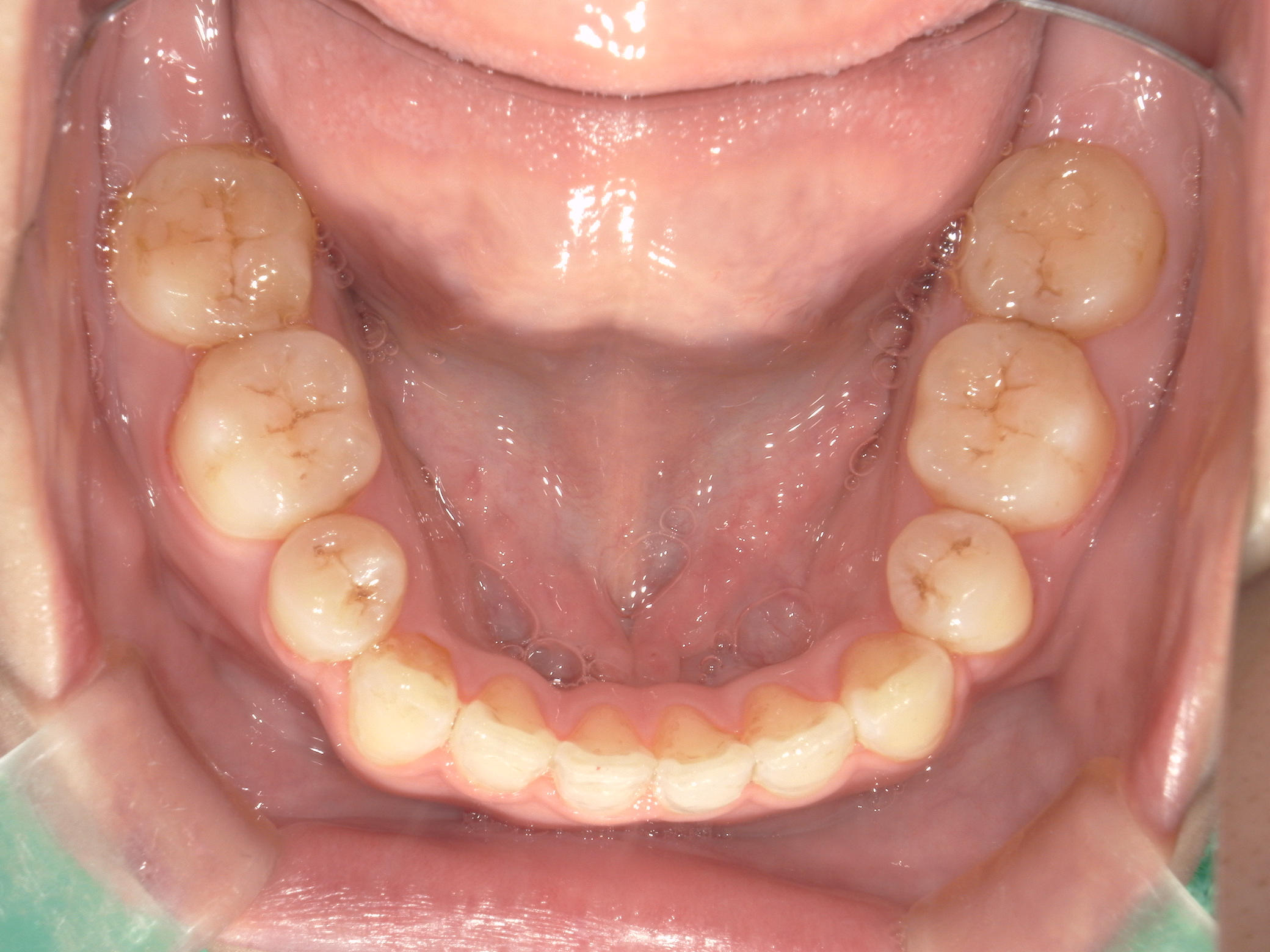 舌側ワイヤー矯正　症例（28）