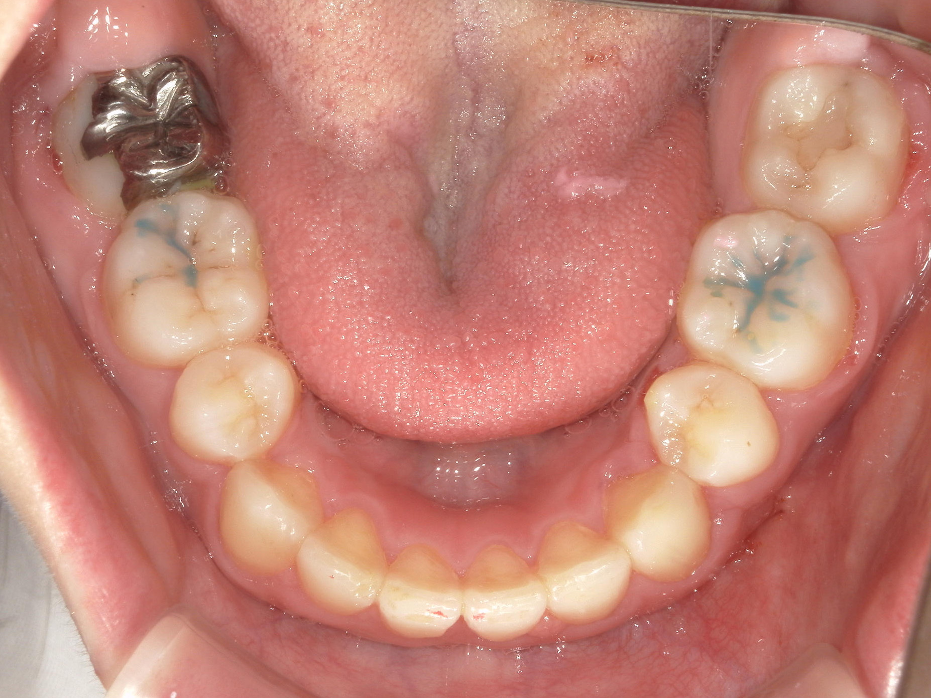 舌側ワイヤー矯正　症例（29）