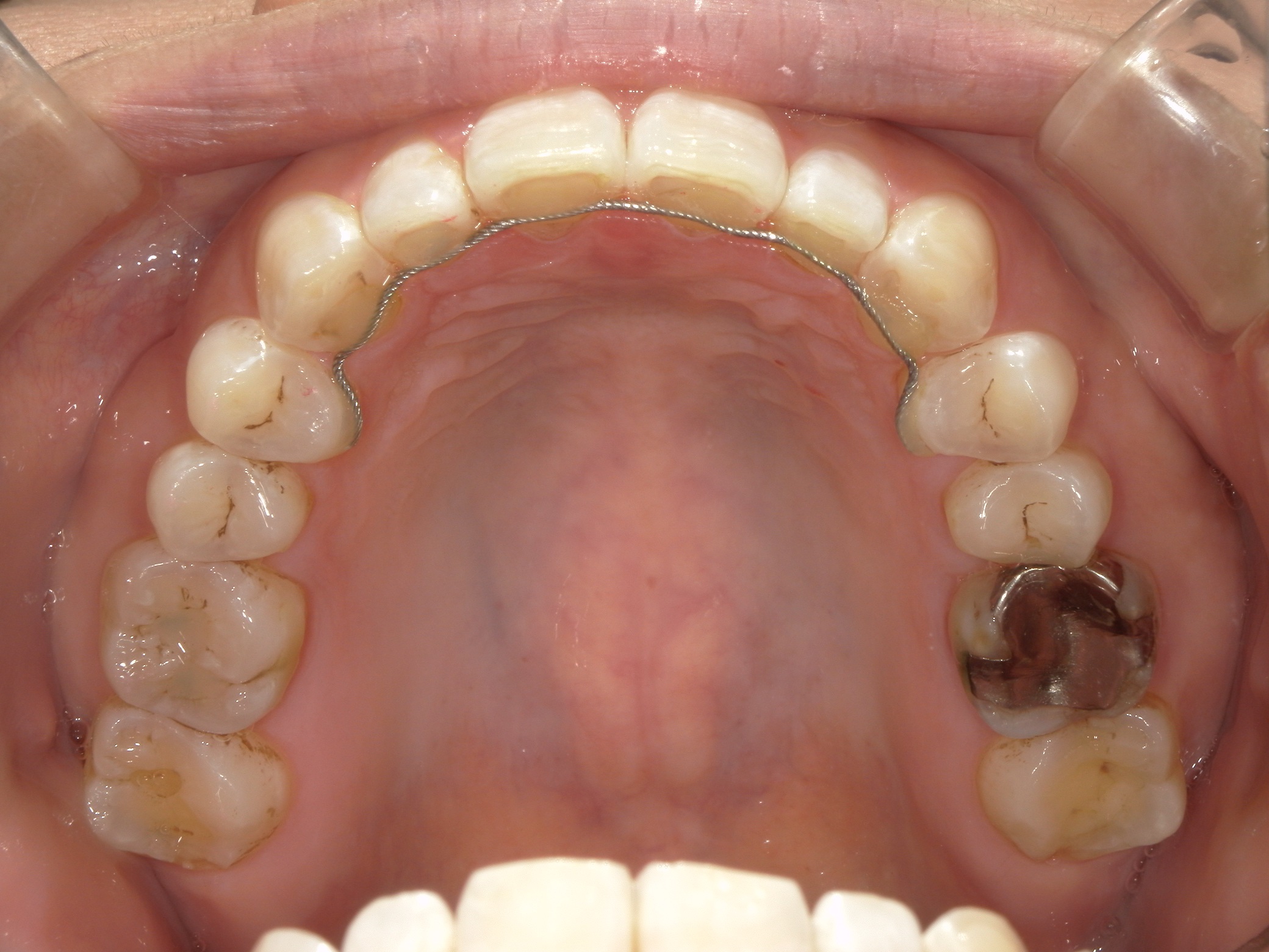 プチ舌側ワイヤー矯正　症例（31）