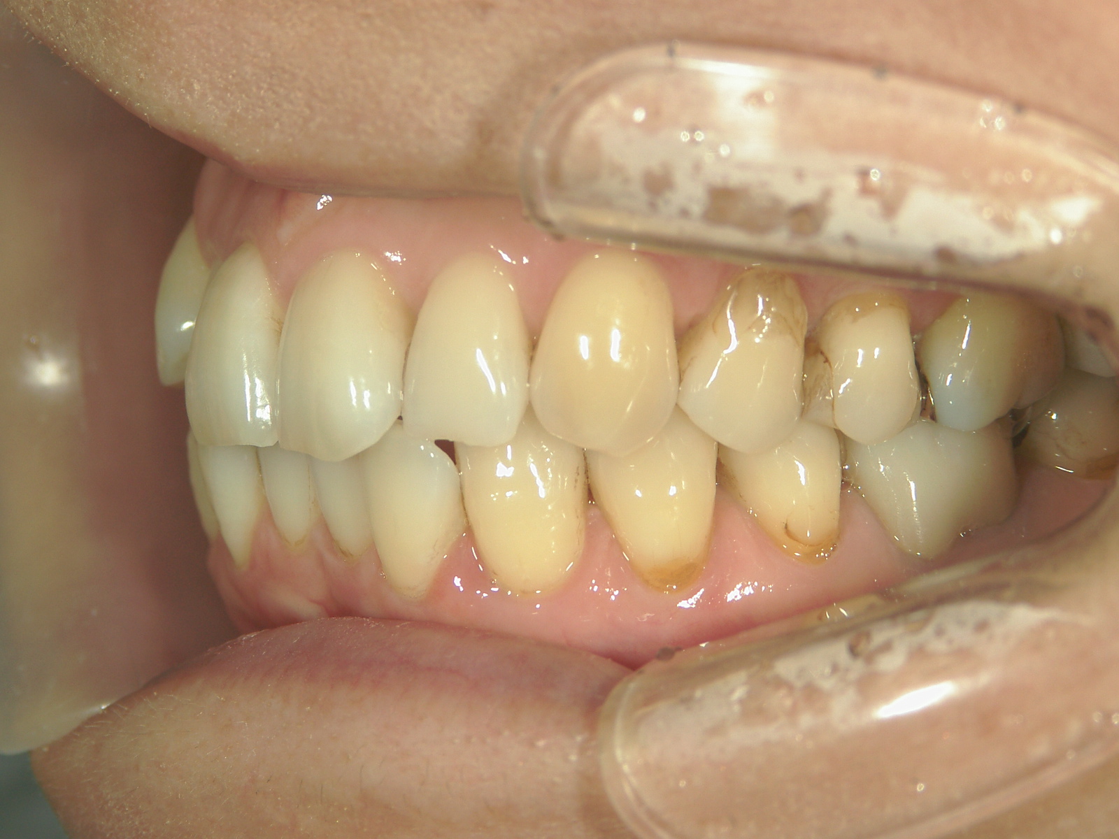 インビザライン矯正　症例（25）