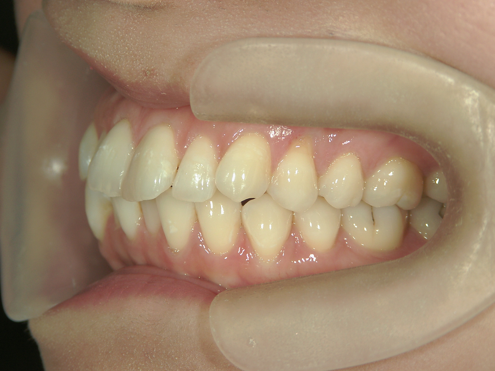 インビザライン矯正　症例（26）